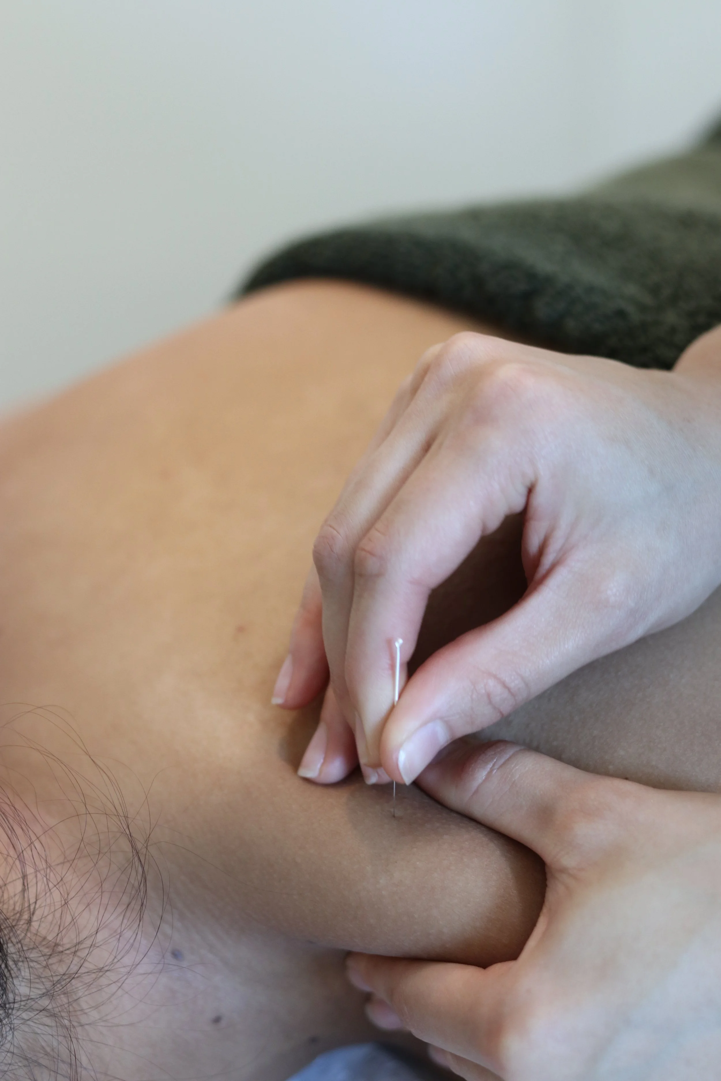 Person receiving dry needling treatment with fine needle inserted into skin.