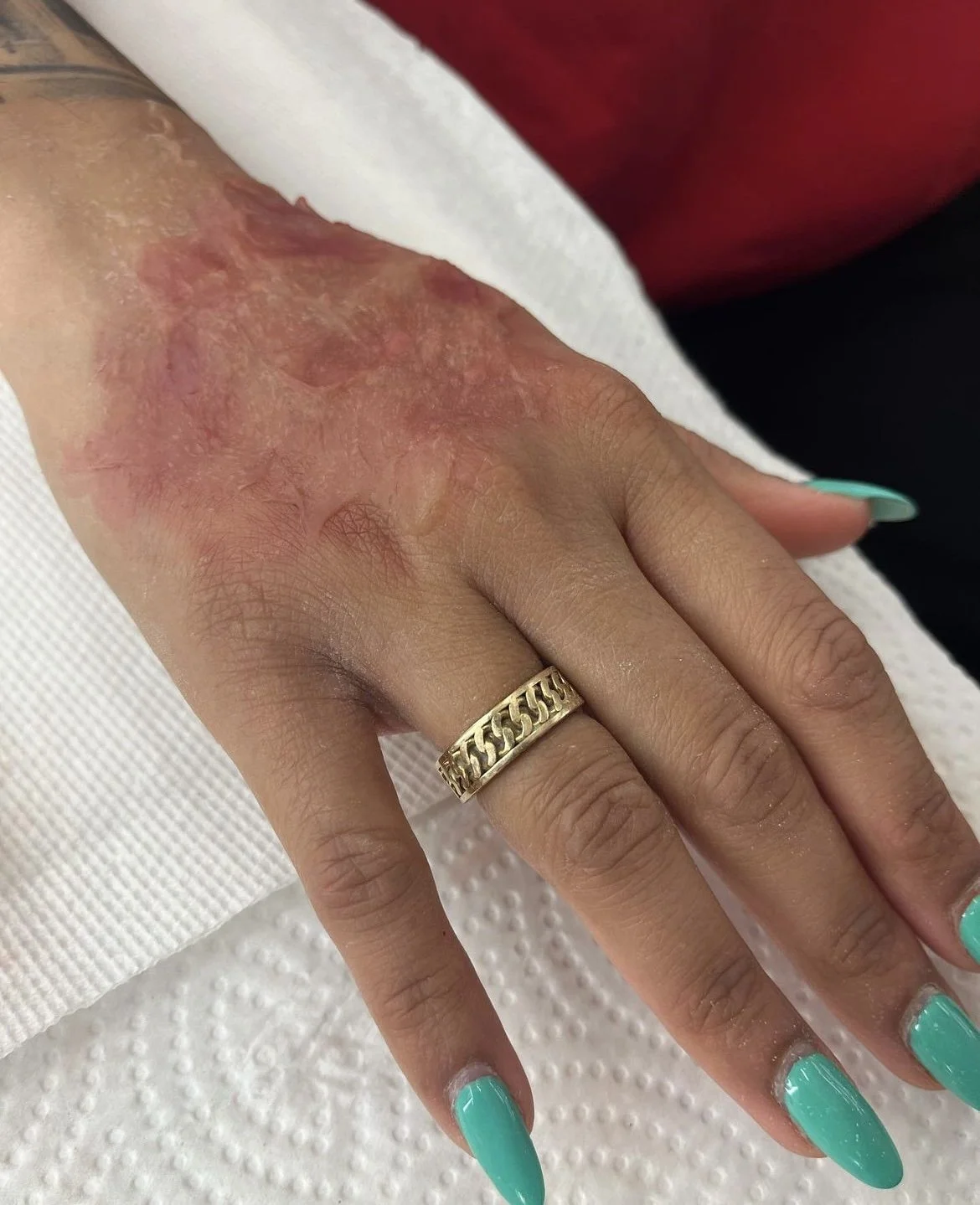 SFX Contracture Scarring