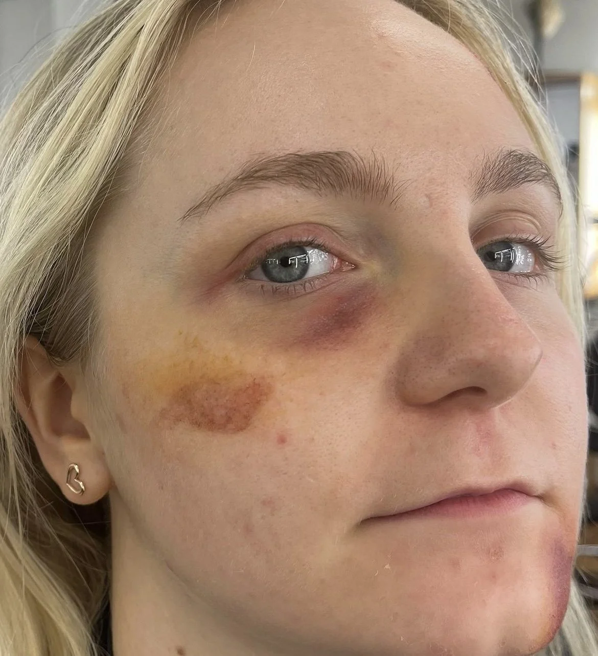 SFX Bruising