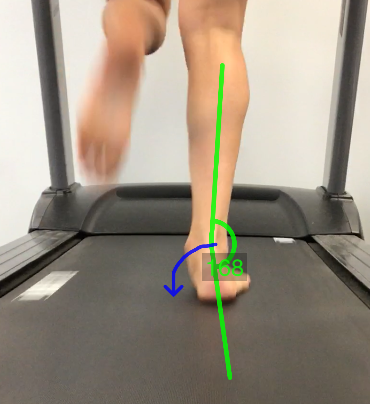 Rear-view kinematic video evaluation measuring barefoot ankle pronation angle and foot mechanics for running footwear prescription.