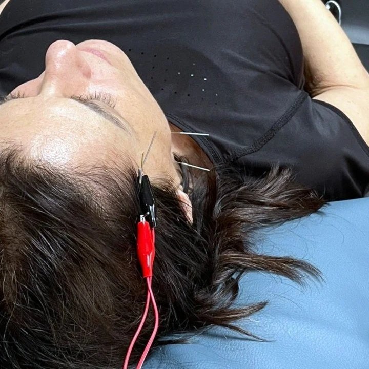 Patient receiving specialized TMJ dry needling with neuromuscular electrical stimulation at Athletic Joint in Marietta, GA.