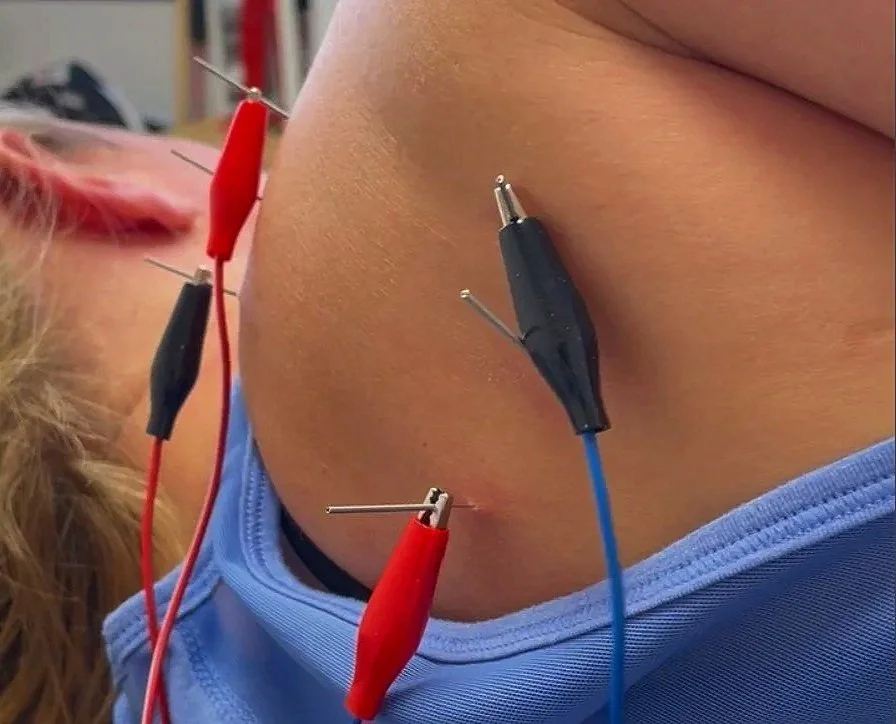 trigger point dry needling of a female athlete's shoulder blade muscles with electrical stimulation in a clinical setting at a physical therapy practice.