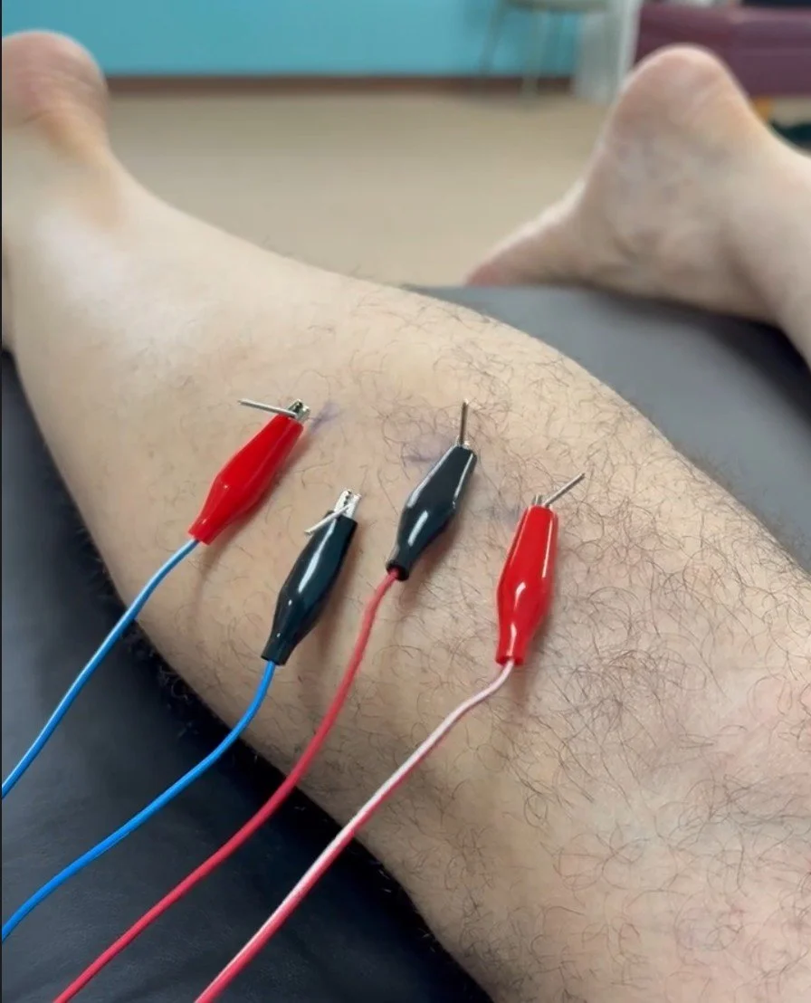 dry needling to the calf muscles of an athletic male