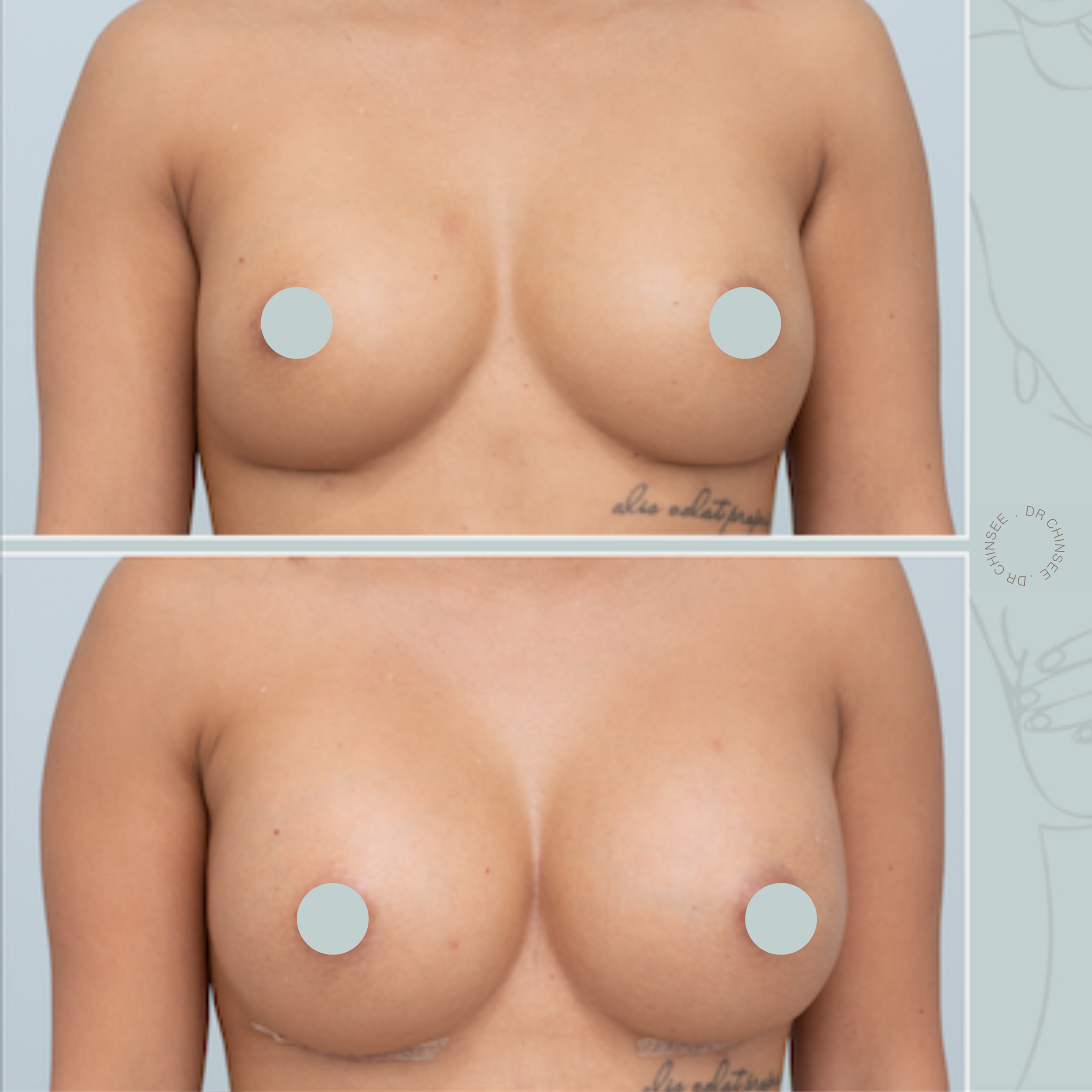 breast revision, removal and replacement, breast surgery, removal and replacement brisbane, breast revision brisbane, mastopexy brisbane, cosmetic breast surgery, dr ian chinsee