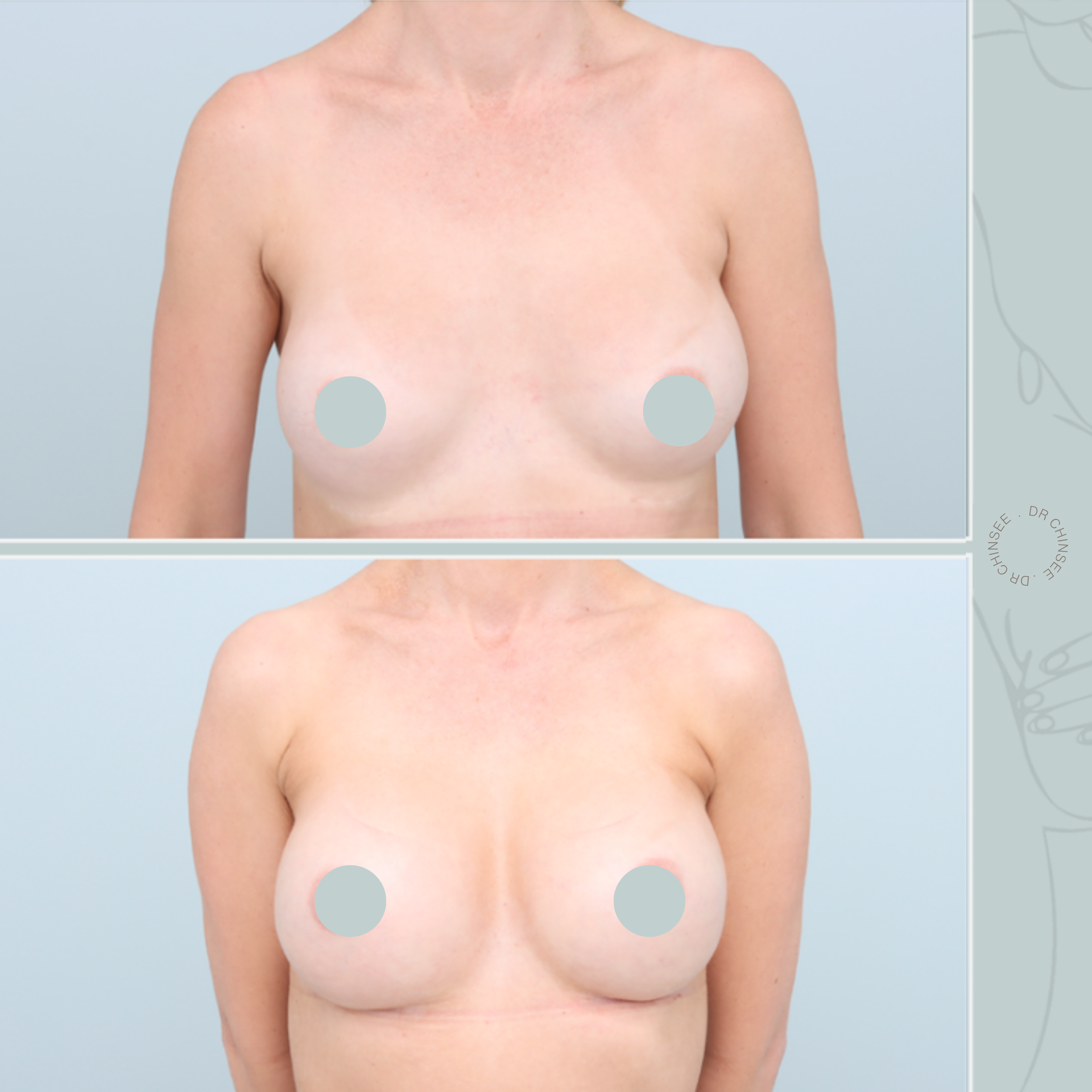 breast revision, removal and replacement, breast surgery, removal and replacement brisbane, breast revision brisbane, mastopexy brisbane, cosmetic breast surgery, dr ian chinsee