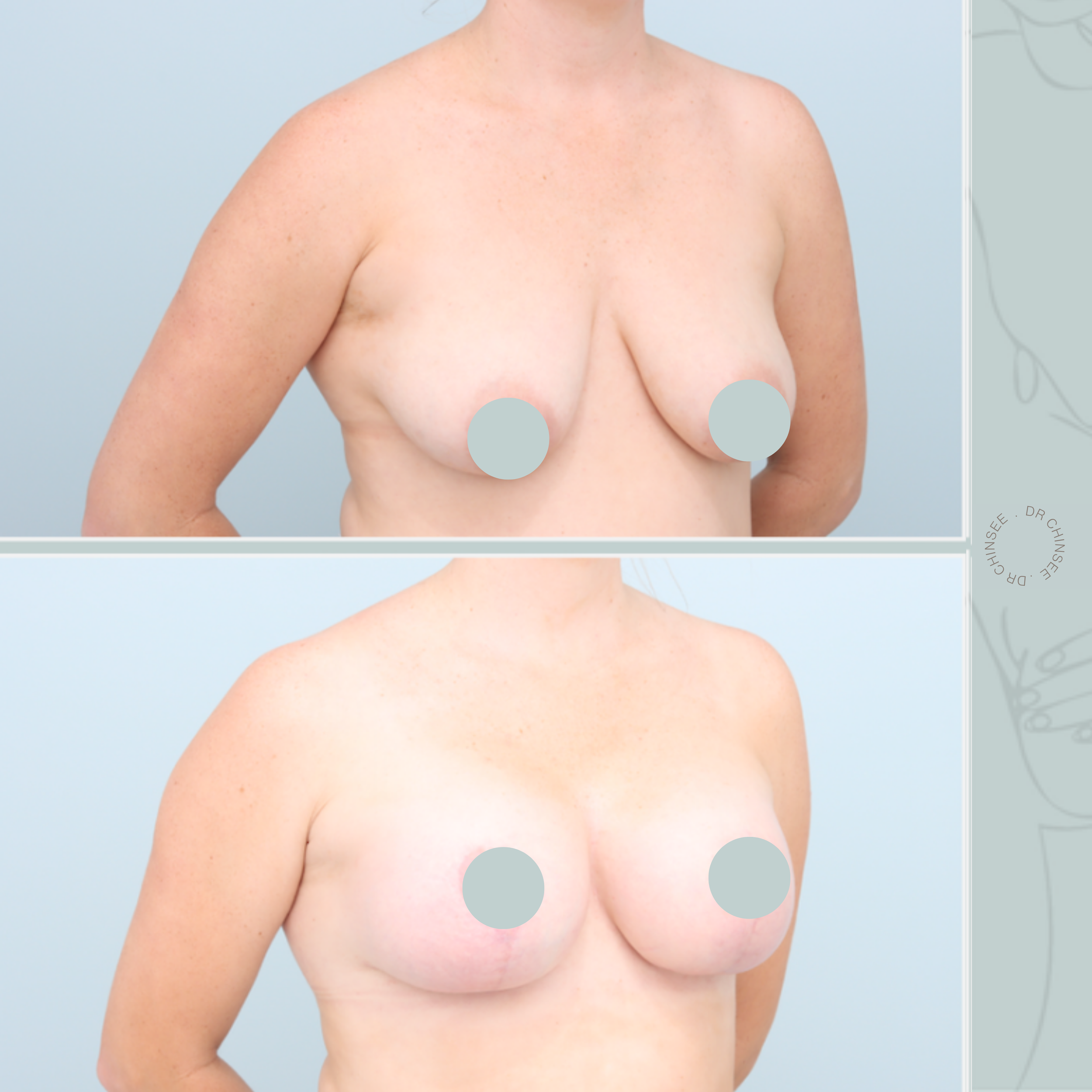 breast augmentation & mastopexy, breast lift, breast surgery, breast augmentation brisbane, breast lift brisbane, mastopexy brisbane, cosmetic breast surgery, dr ian chinsee