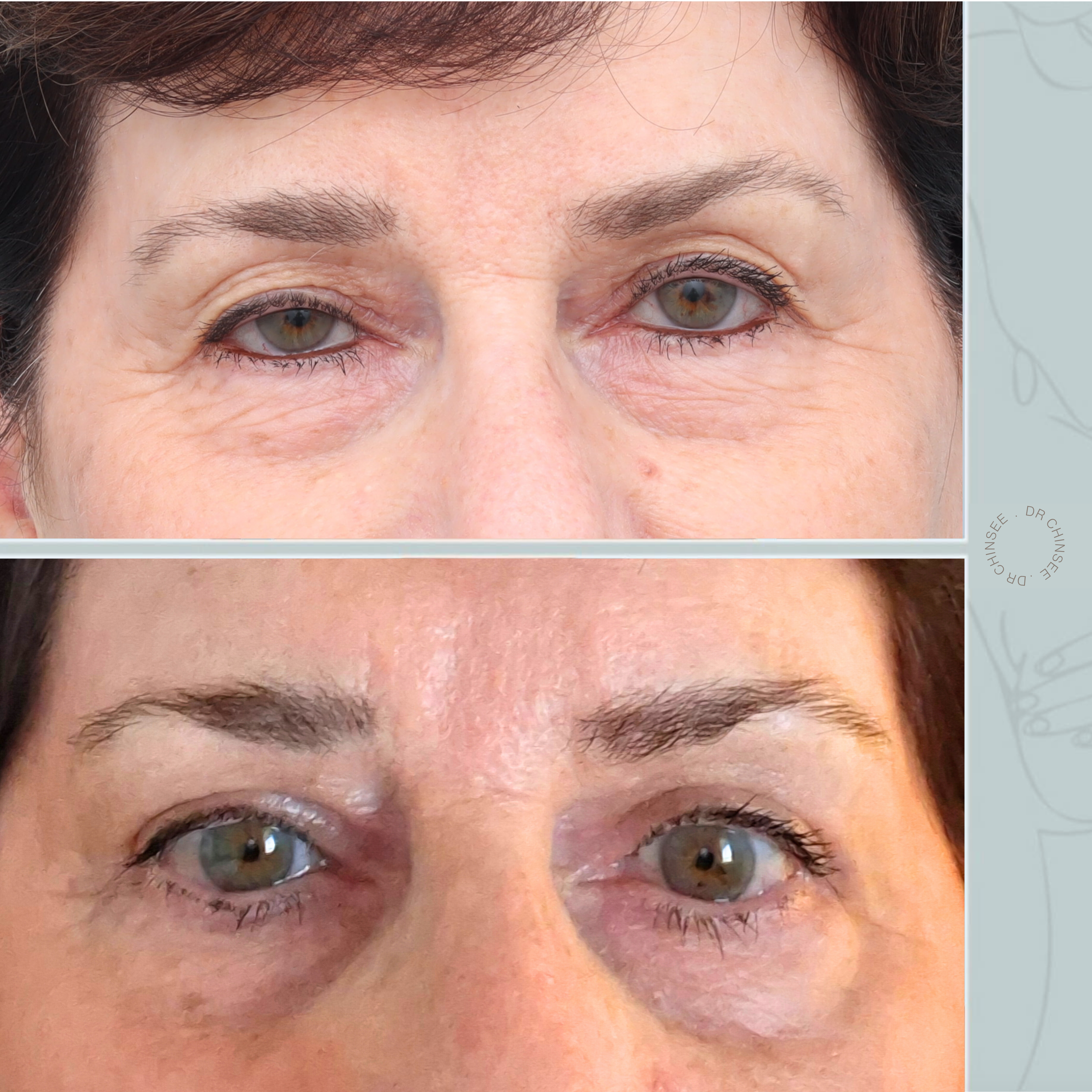 blepharoplasty, blepharoplasty brisbane, brisbane cosmetic clinics, brisbane facial surgery, dr ian chinsee, brisbane cosmetic surgery