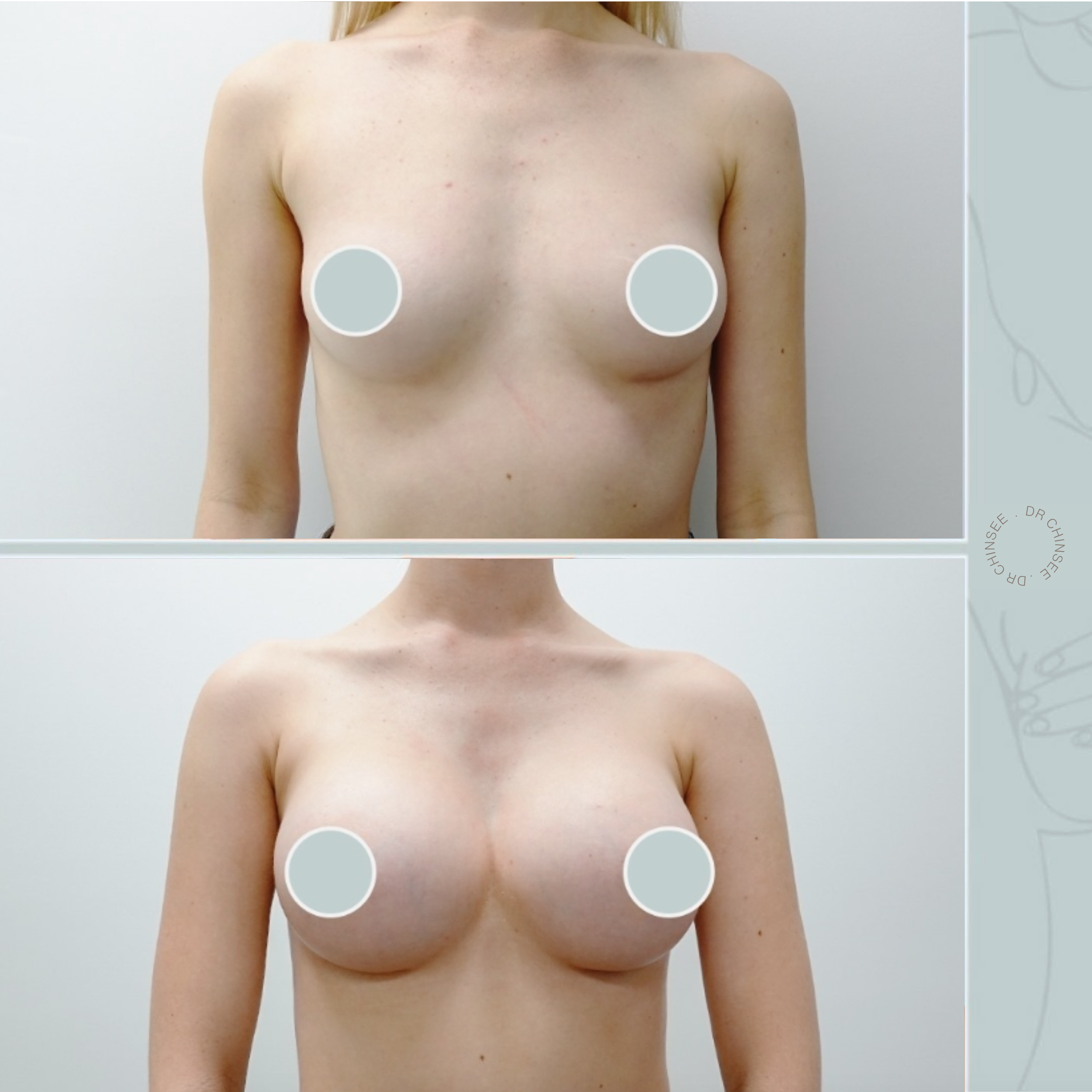 breast augmentation, breast surgery, breast augmentation brisbane, cosmetic breast surgery, dr ian chinsee