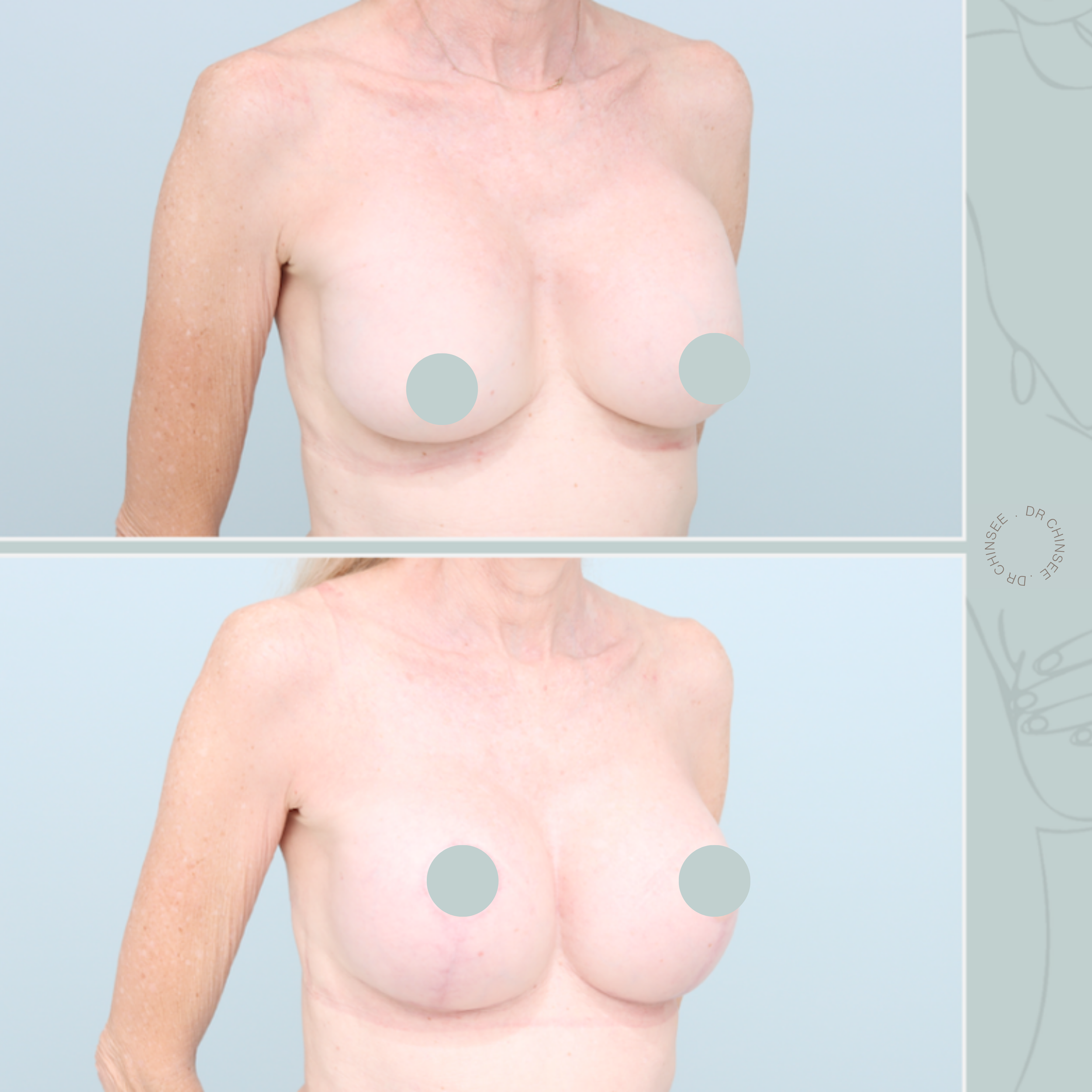 breast revision, removal and replacement, breast surgery, removal and replacement brisbane, breast revision brisbane, mastopexy brisbane, cosmetic breast surgery, dr ian chinsee