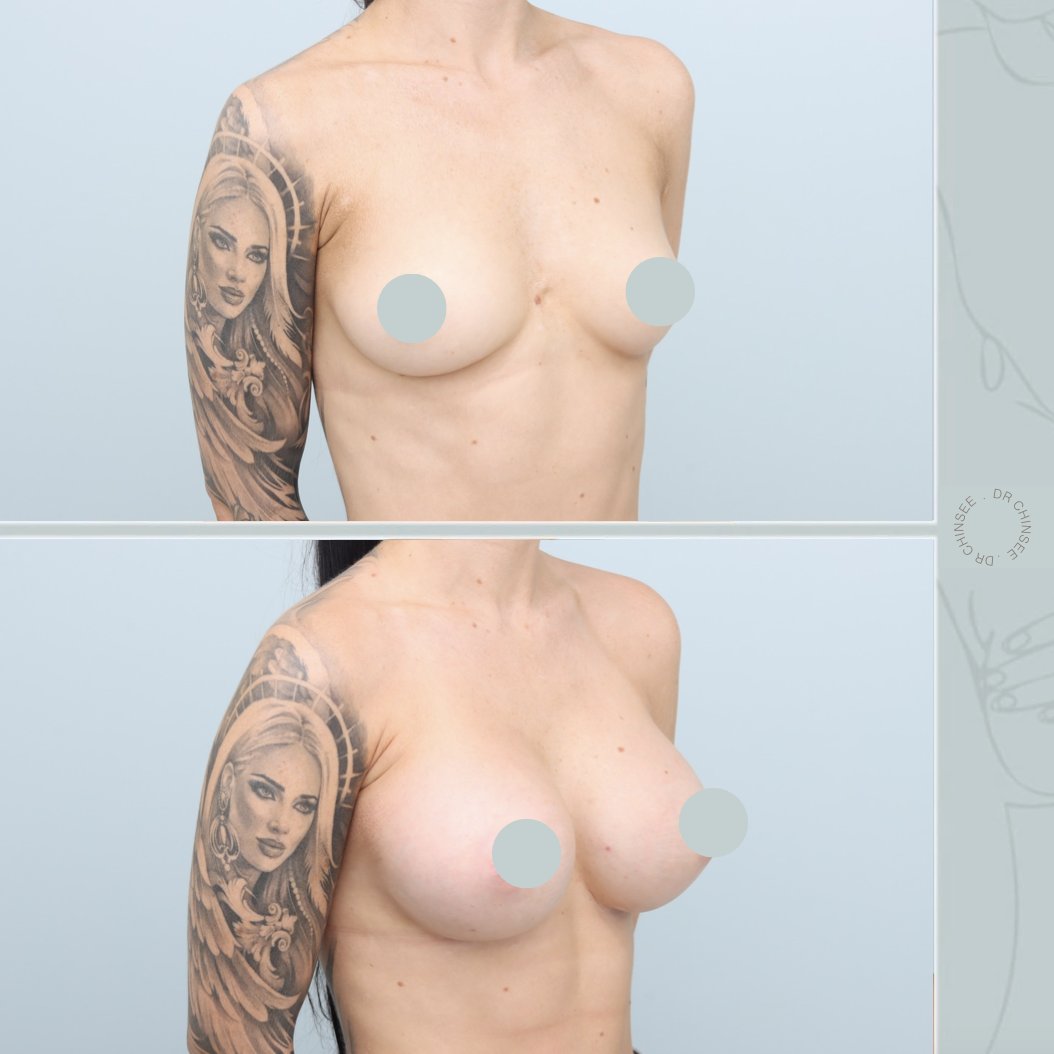 breast augmentation, breast surgery, breast augmentation brisbane, cosmetic breast surgery, dr ian chinsee