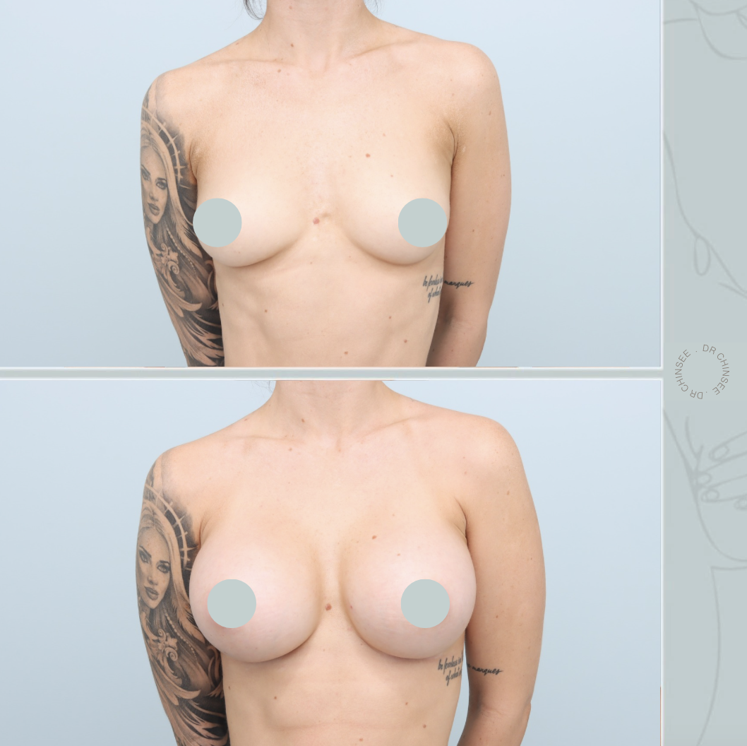 breast augmentation, breast surgery, breast augmentation brisbane, cosmetic breast surgery, dr ian chinsee