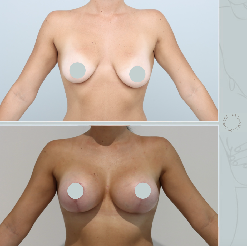 breast augmentation & mastopexy, breast lift, breast surgery, breast augmentation brisbane, breast lift brisbane, mastopexy brisbane, cosmetic breast surgery, dr ian chinsee