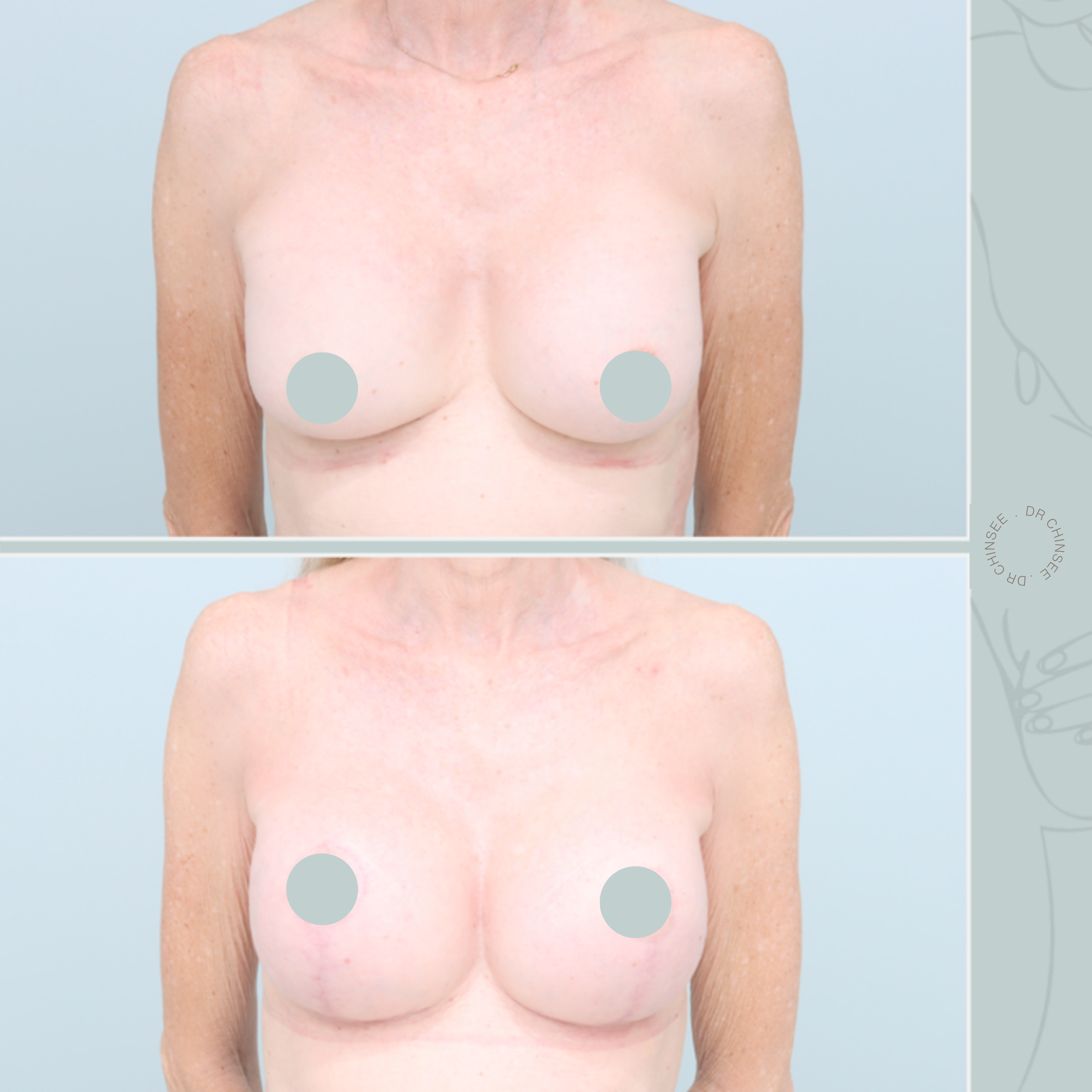 breast revision, removal and replacement, breast surgery, removal and replacement brisbane, breast revision brisbane, mastopexy brisbane, cosmetic breast surgery, dr ian chinsee