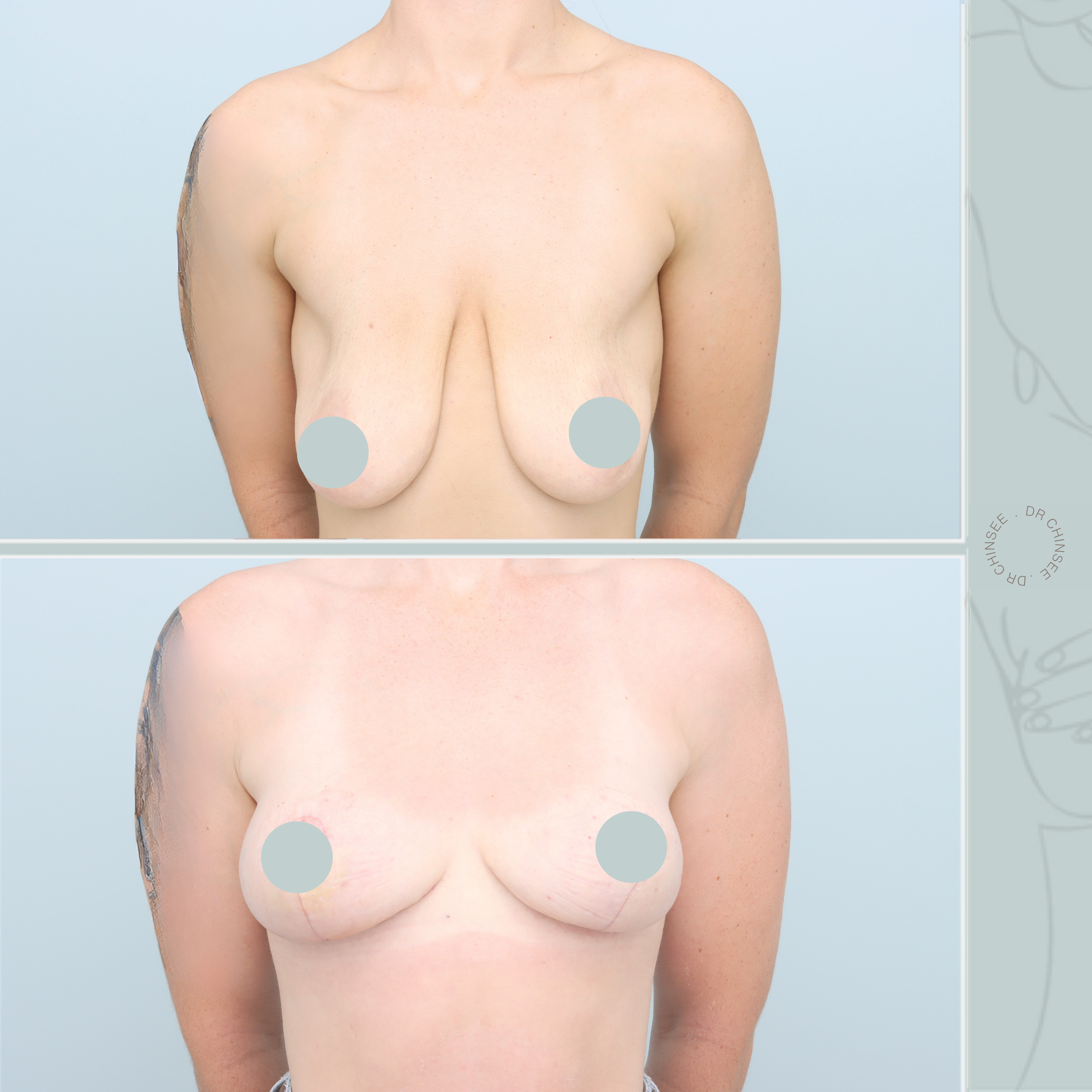 Mastopexy, breast lift, breast surgery, breast lift brisbane, mastopexy brisbane, cosmetic breast surgery, dr ian chinsee