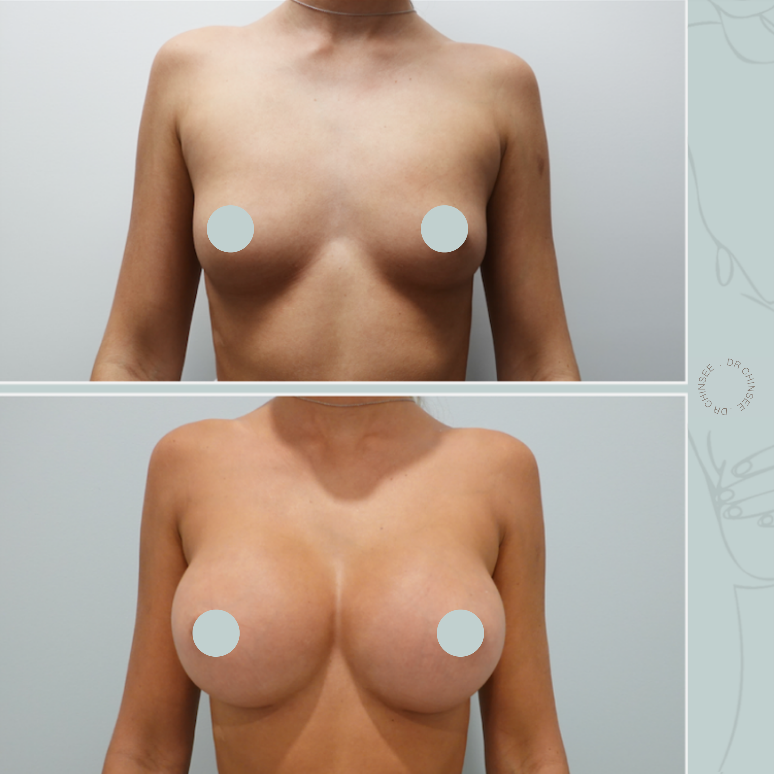 breast augmentation, breast surgery, breast augmentation brisbane, cosmetic breast surgery, dr ian chinsee