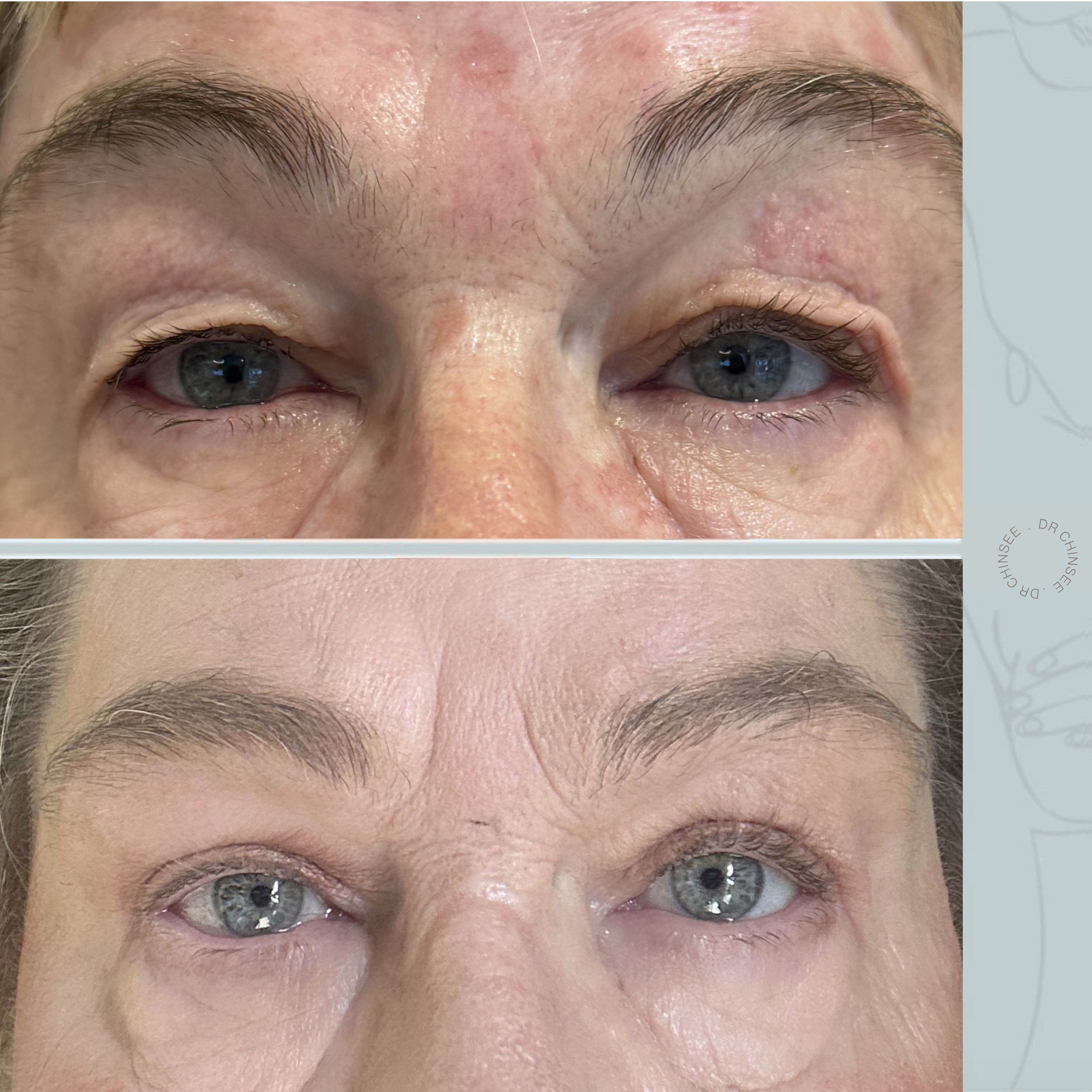 blepharoplasty, blepharoplasty brisbane, brisbane cosmetic clinics, brisbane facial surgery, dr ian chinsee, brisbane cosmetic surgery