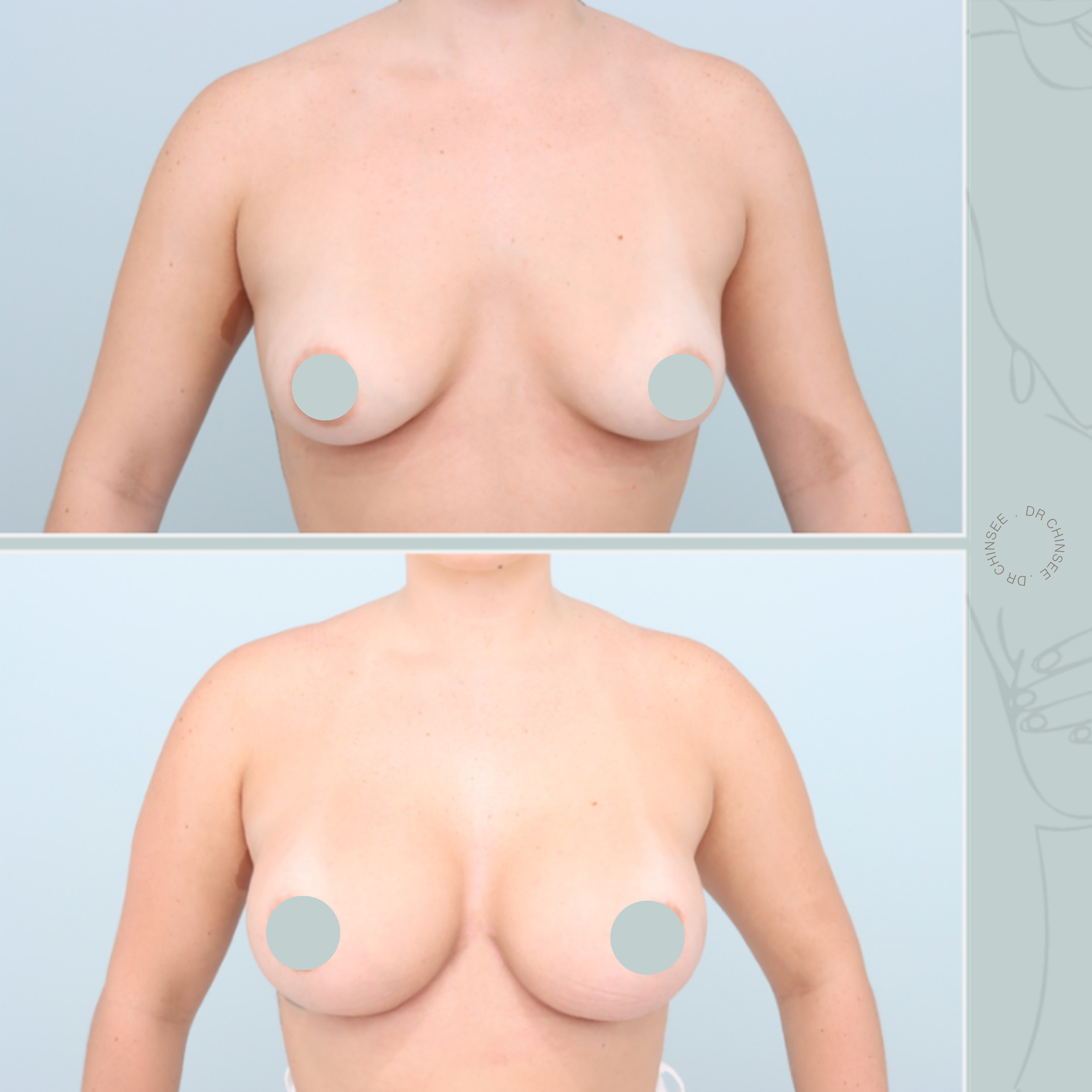breast augmentation, breast surgery, breast augmentation brisbane, cosmetic breast surgery, dr ian chinsee