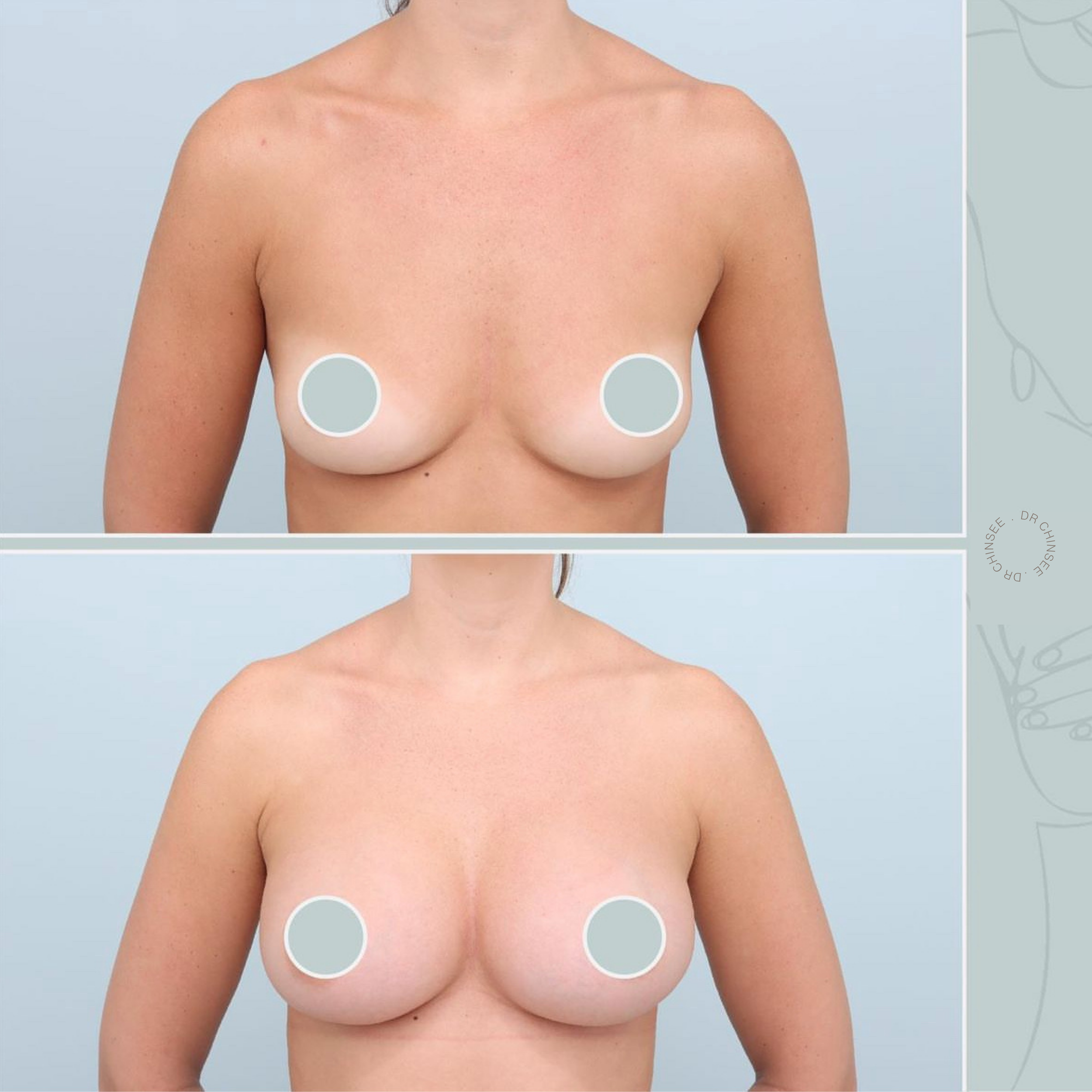 breast augmentation, breast surgery, breast augmentation brisbane, cosmetic breast surgery, dr ian chinsee