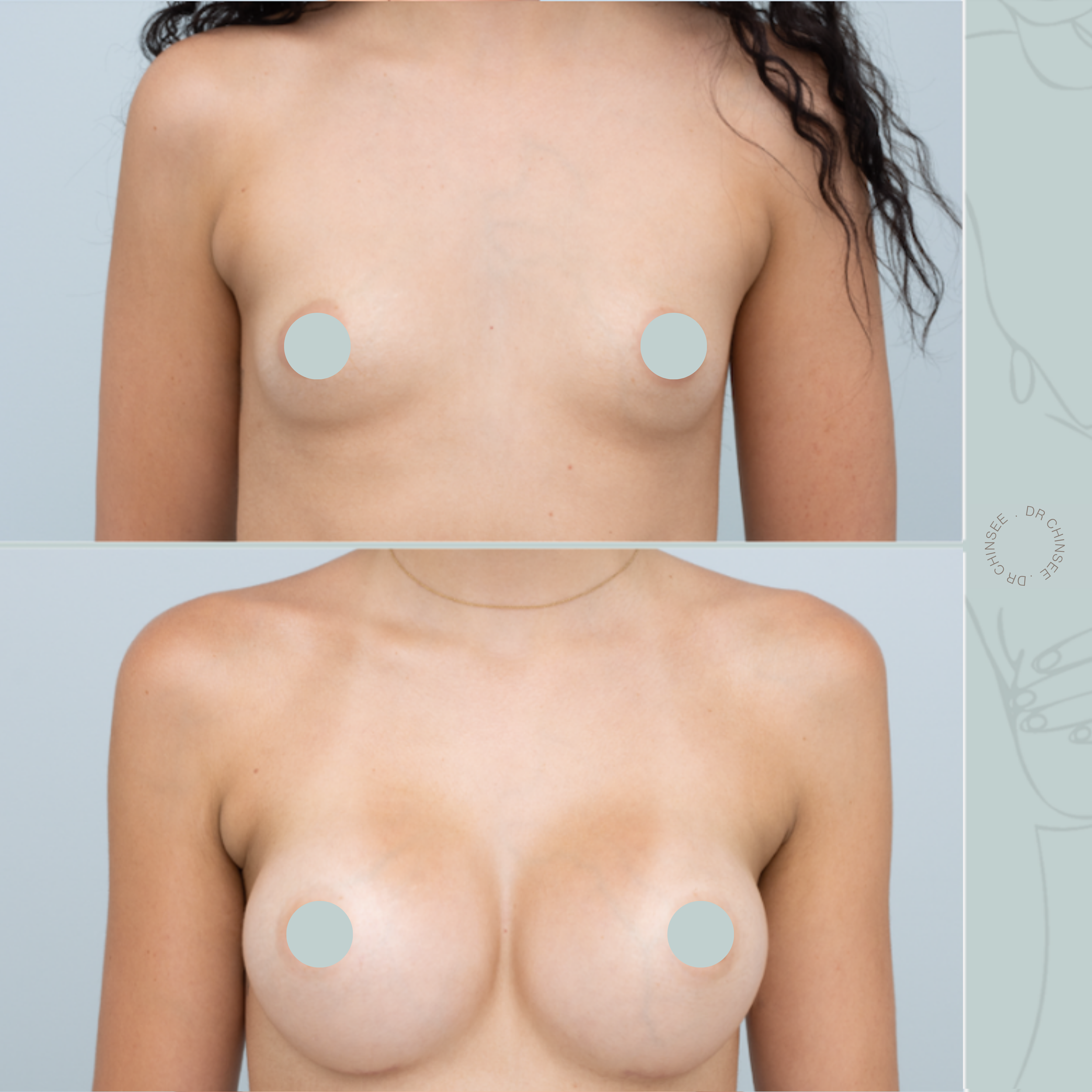 breast augmentation, breast surgery, breast augmentation brisbane, cosmetic breast surgery, dr ian chinsee