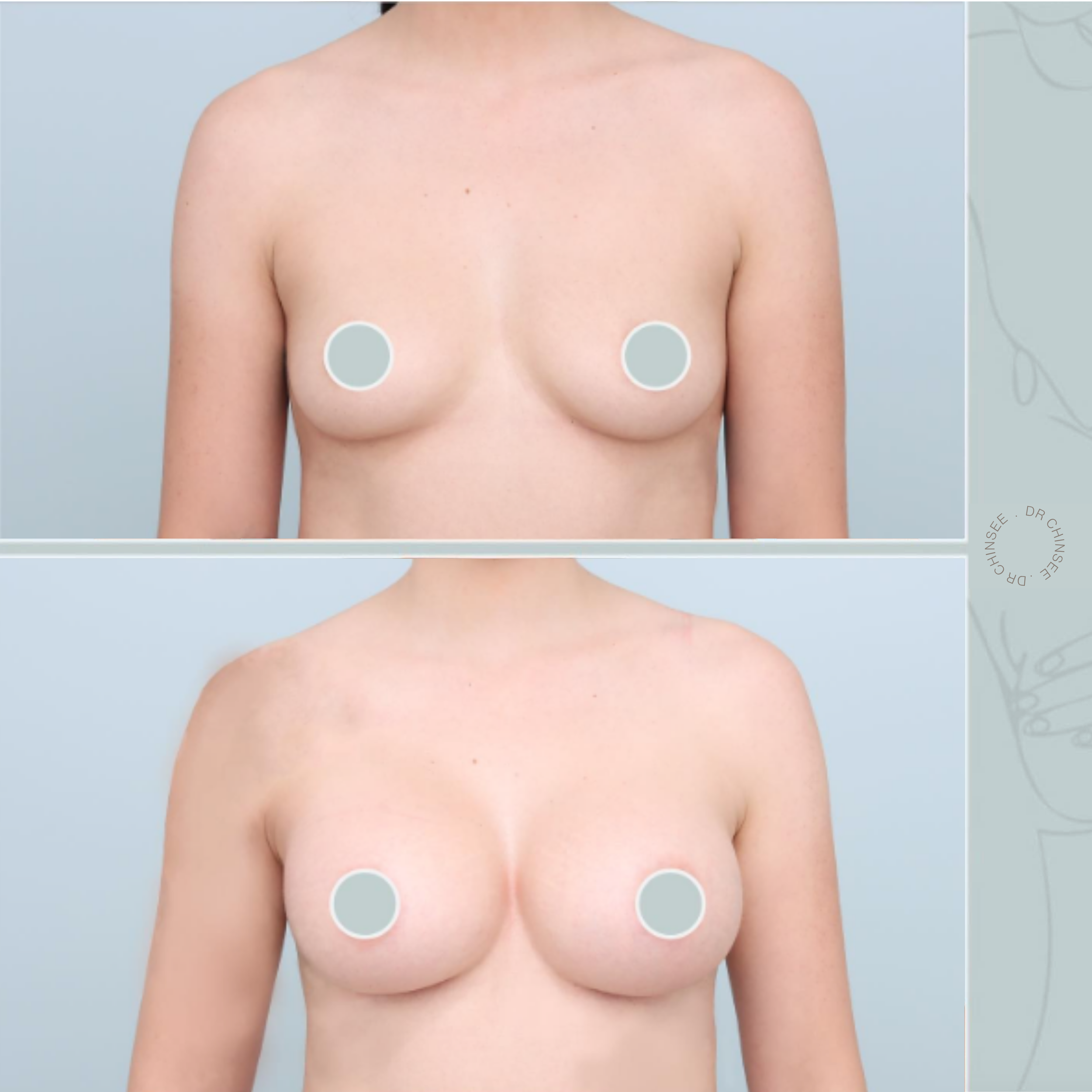 breast augmentation, breast surgery, breast augmentation brisbane, cosmetic breast surgery, dr ian chinsee