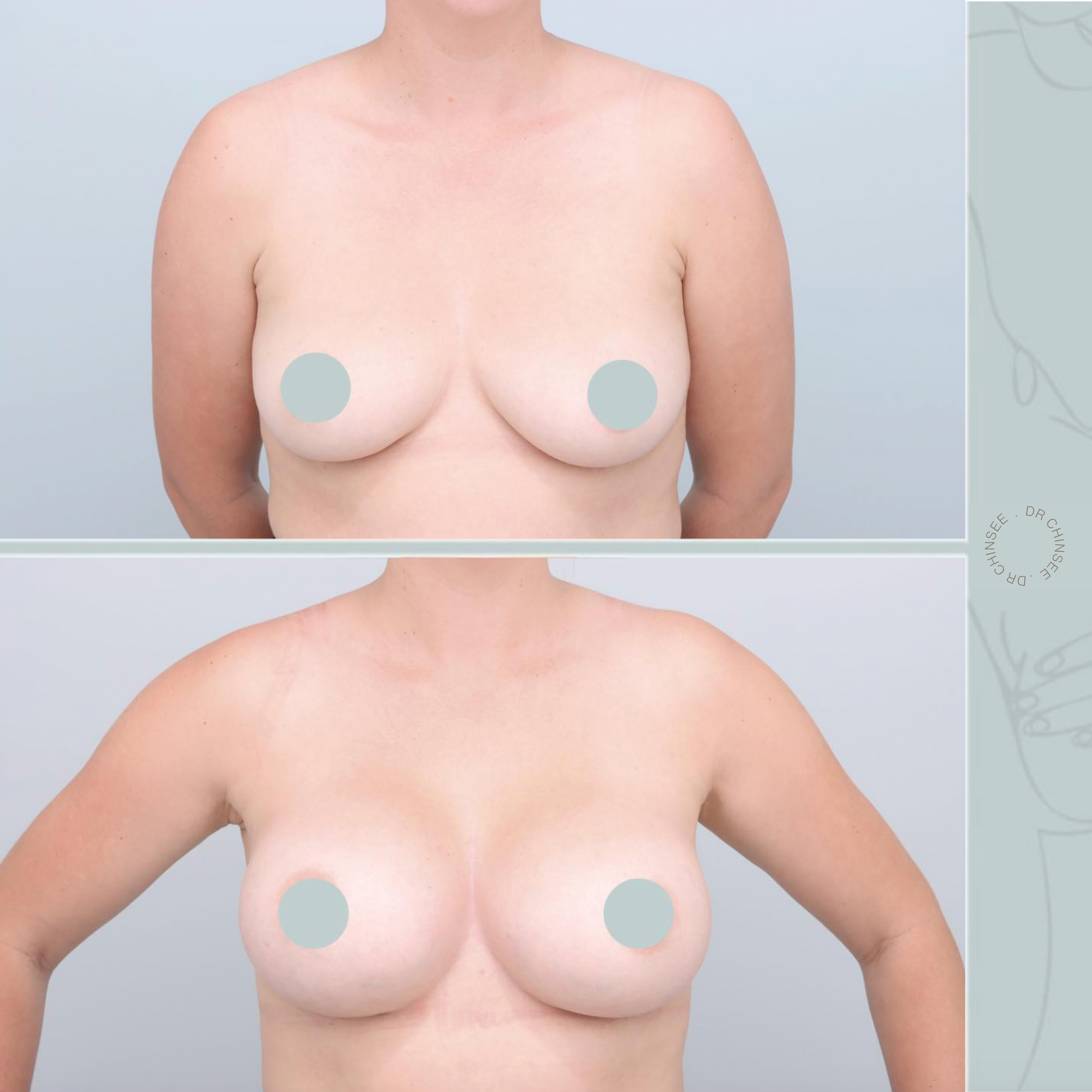 breast augmentation, breast surgery, breast augmentation brisbane, cosmetic breast surgery, dr ian chinsee