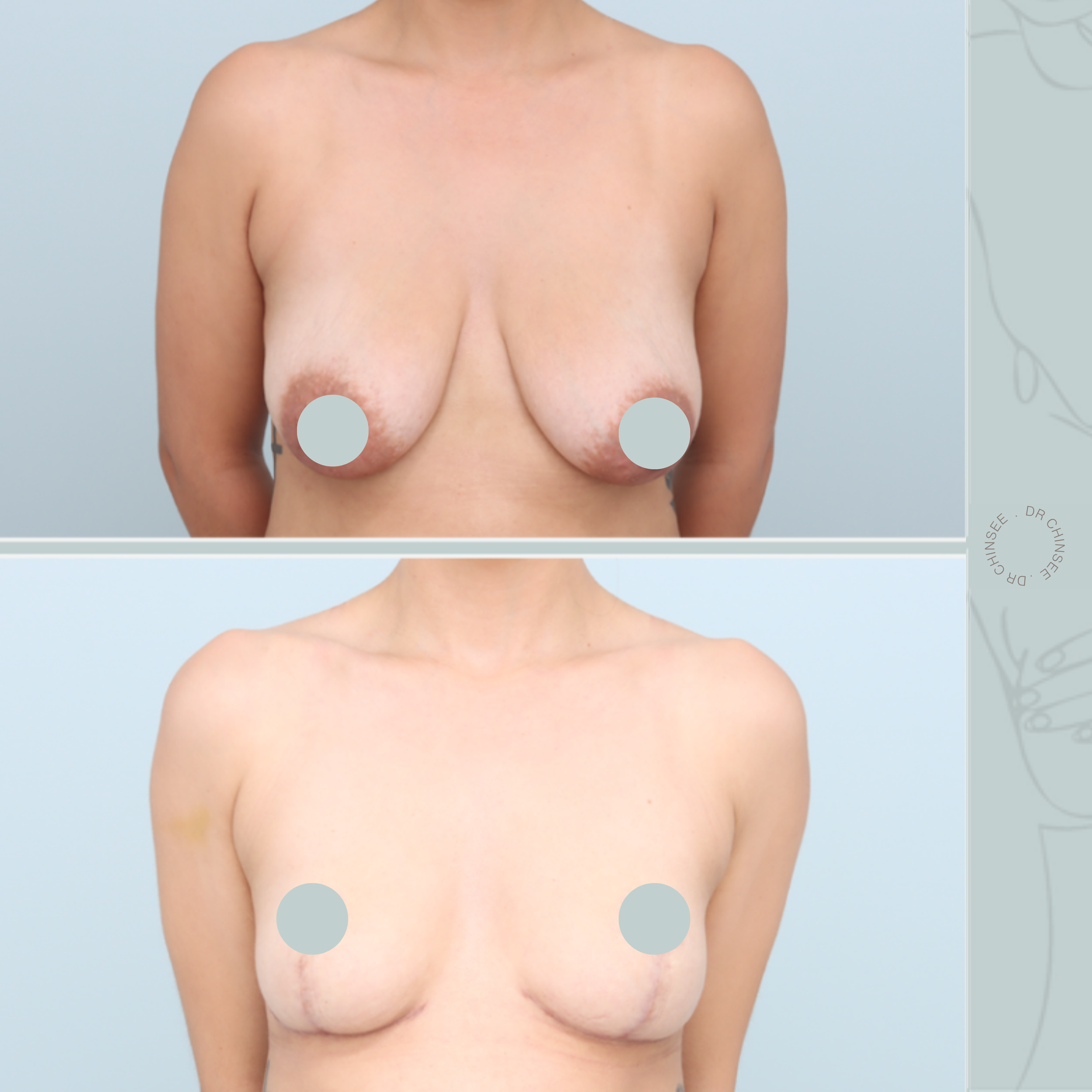 Mastopexy, breast lift, breast surgery, breast lift brisbane, mastopexy brisbane, cosmetic breast surgery, dr ian chinsee