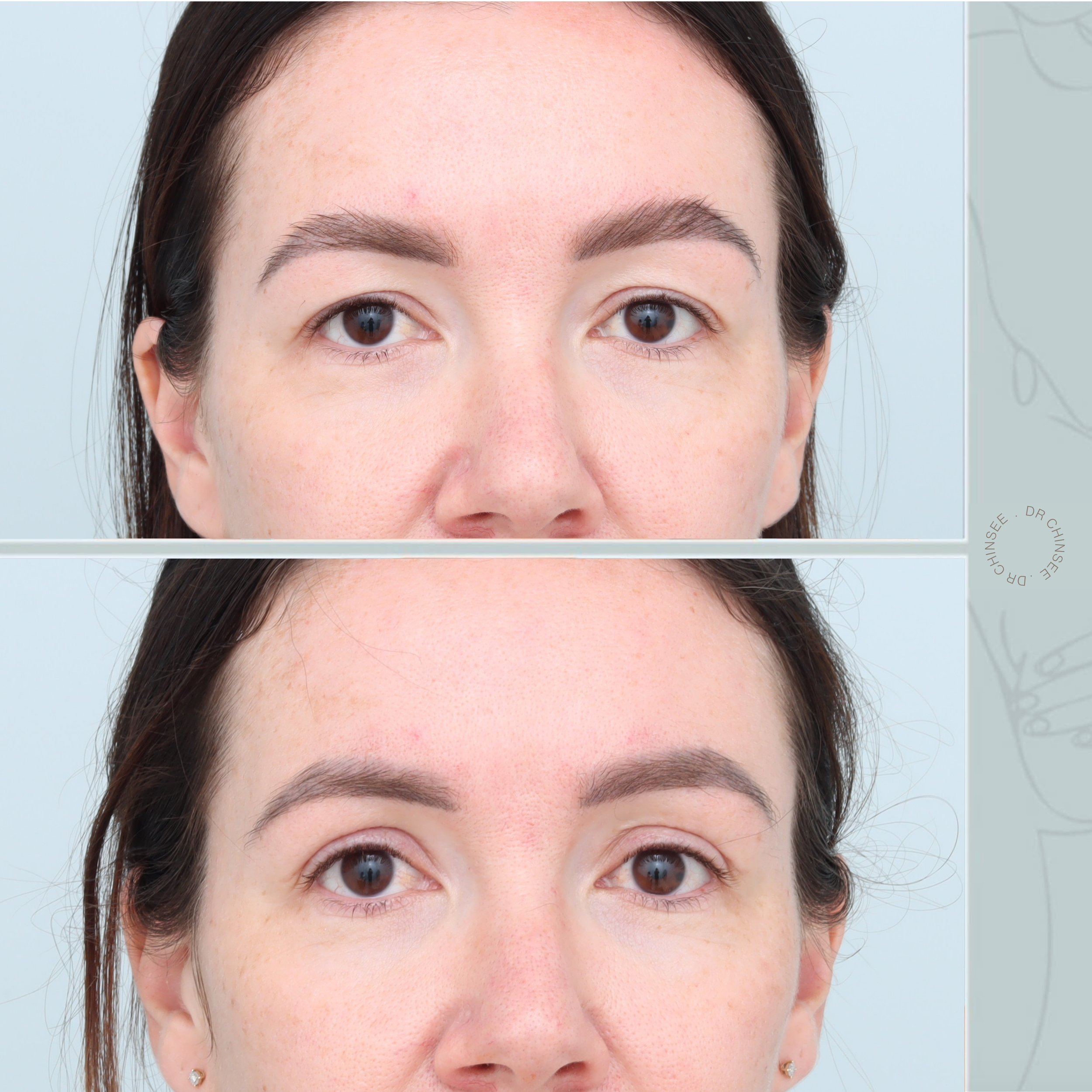blepharoplasty, blepharoplasty brisbane, brisbane cosmetic clinics, brisbane facial surgery, dr ian chinsee, brisbane cosmetic surgery