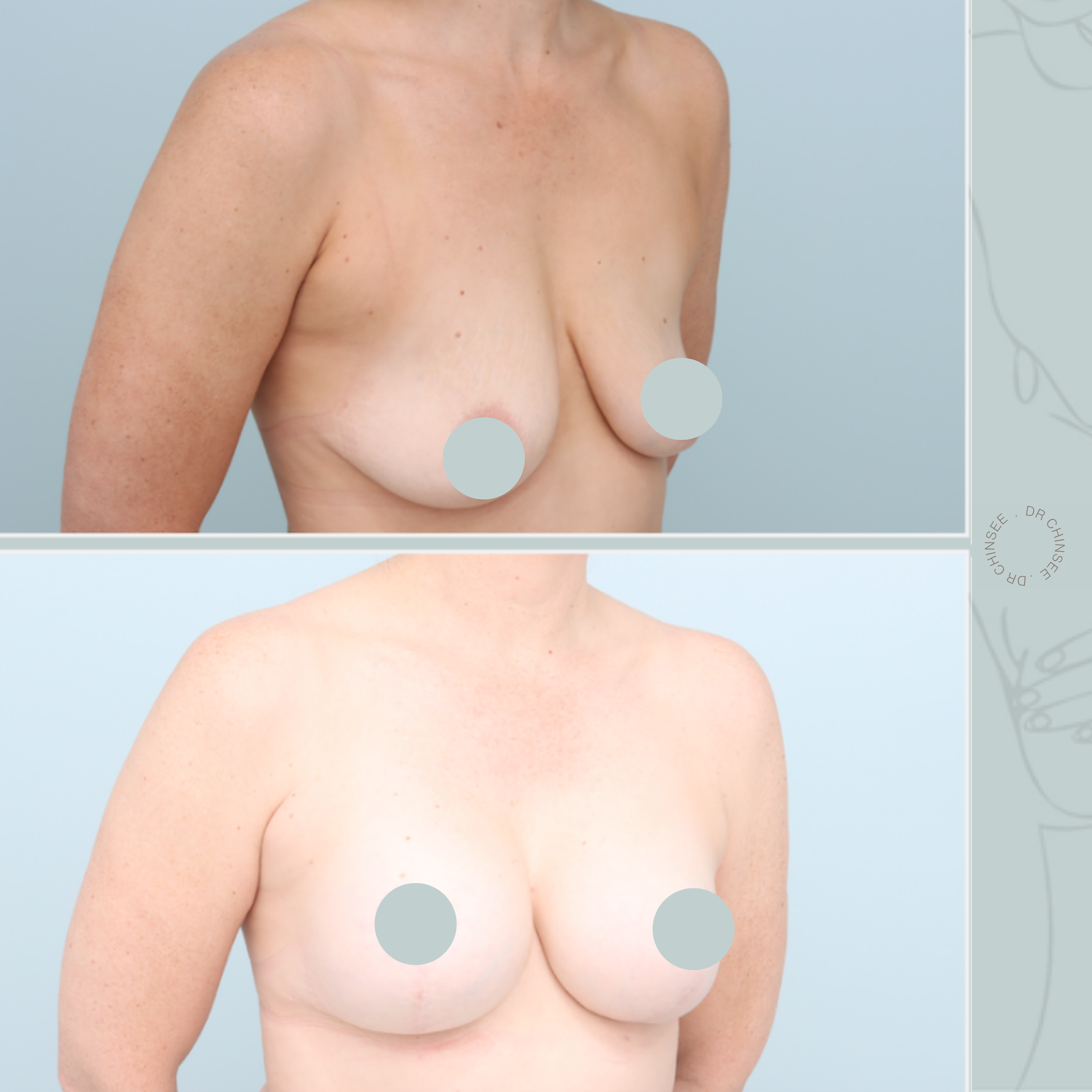 breast augmentation & mastopexy, breast lift, breast surgery, breast augmentation brisbane, breast lift brisbane, mastopexy brisbane, cosmetic breast surgery, dr ian chinsee