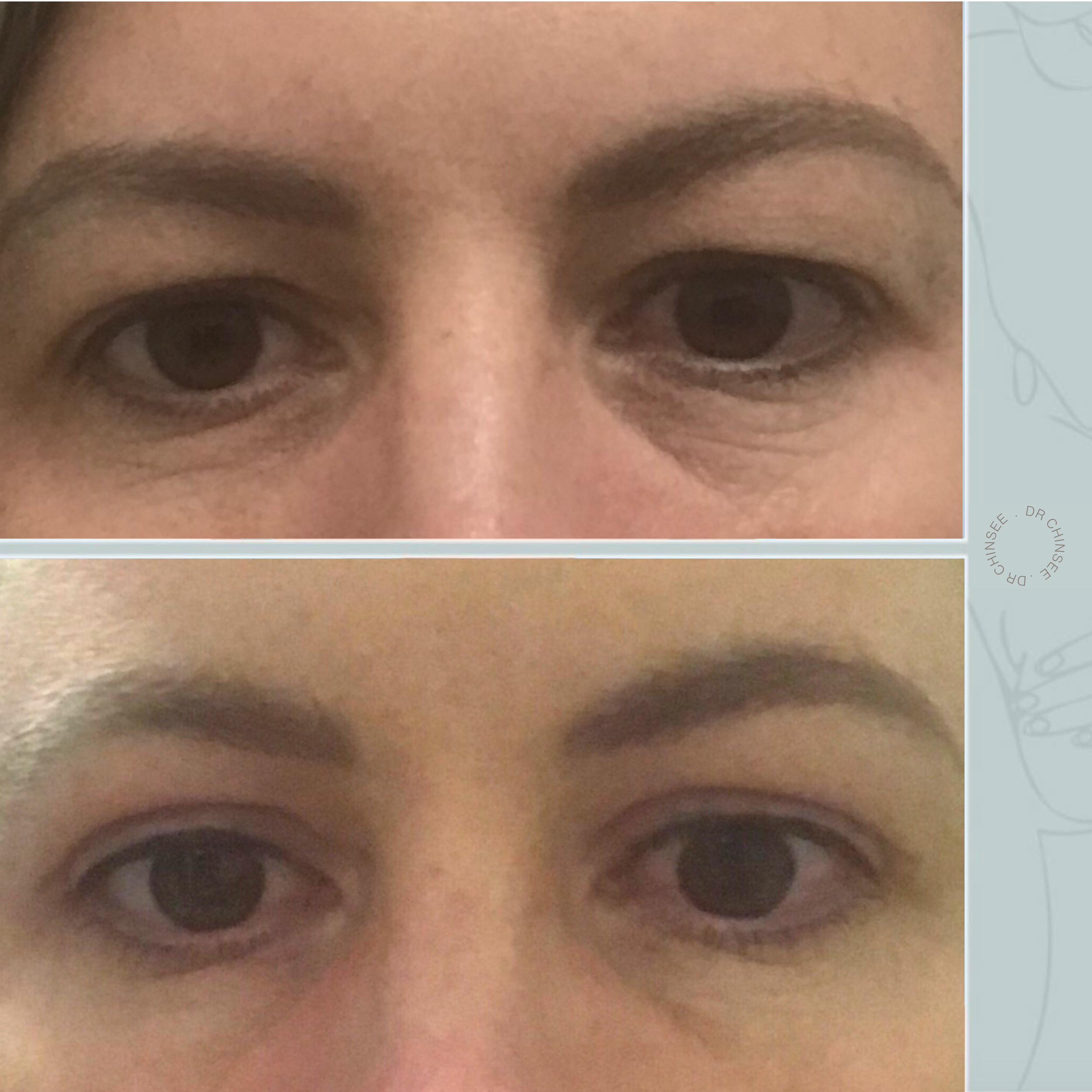 blepharoplasty, blepharoplasty brisbane, brisbane cosmetic clinics, brisbane facial surgery, dr ian chinsee, brisbane cosmetic surgery