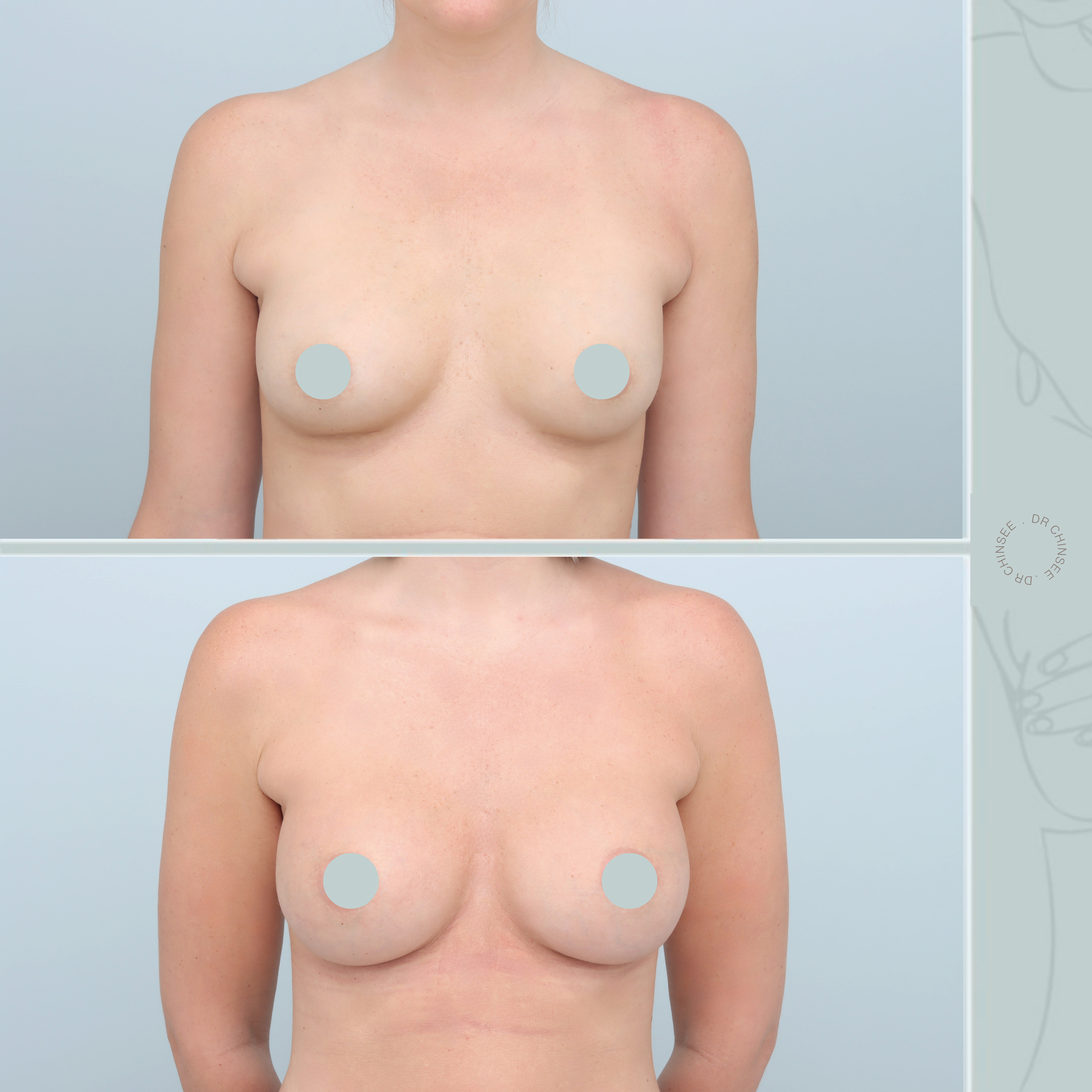 breast augmentation, breast surgery, breast augmentation brisbane, cosmetic breast surgery, dr ian chinsee