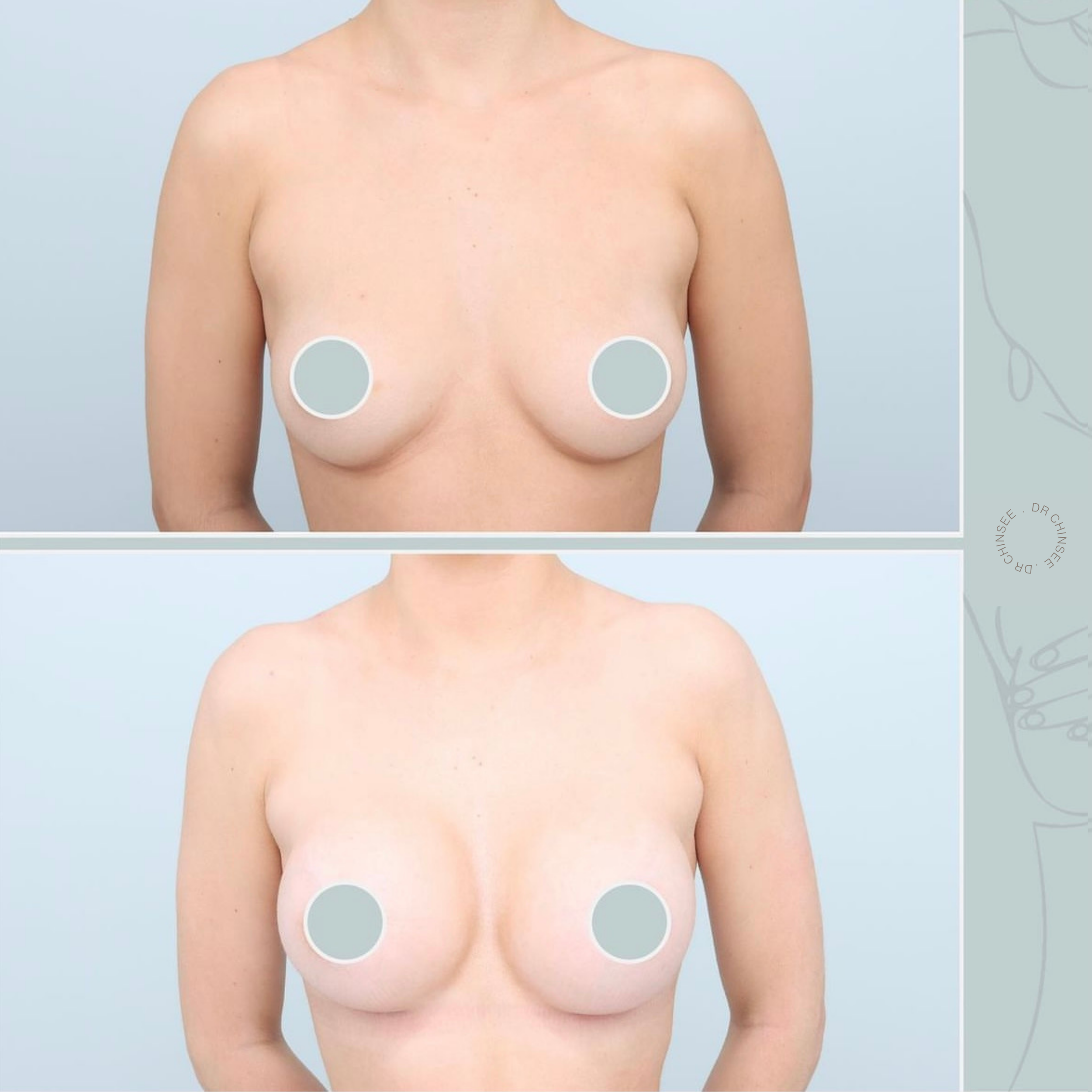 breast augmentation, breast surgery, breast augmentation brisbane, cosmetic breast surgery, dr ian chinsee