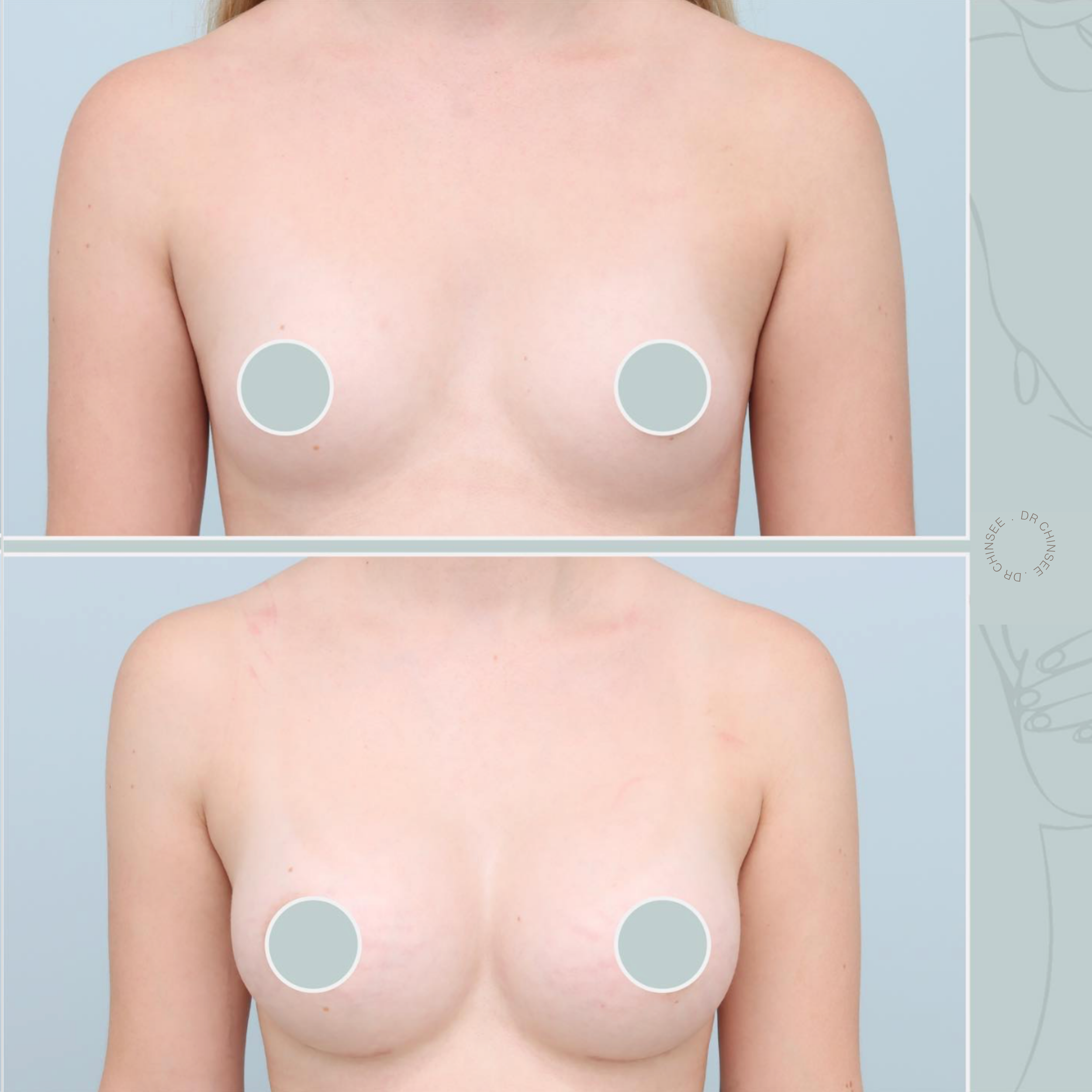 breast augmentation, breast surgery, breast augmentation brisbane, cosmetic breast surgery, dr ian chinsee