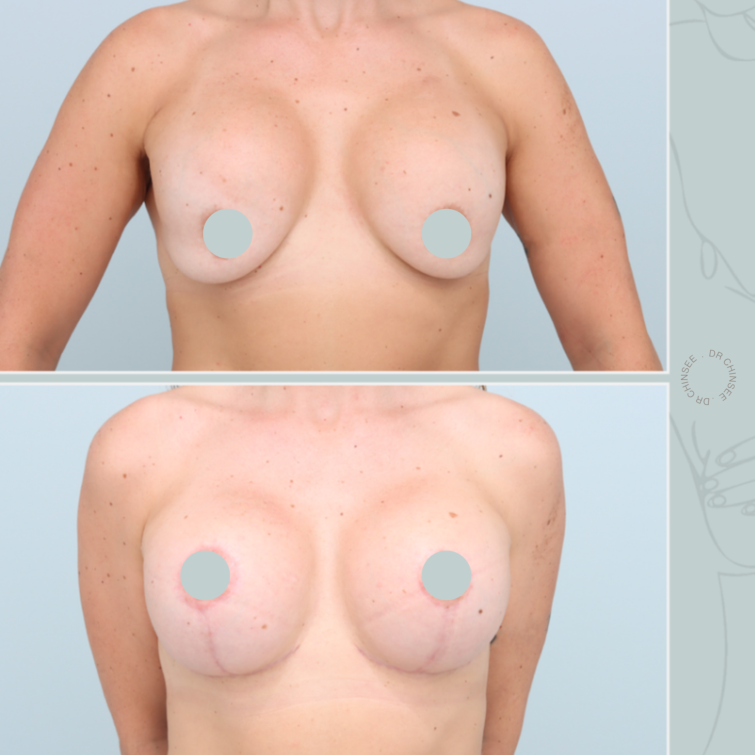 breast revision, removal and replacement, breast surgery, removal and replacement brisbane, breast revision brisbane, mastopexy brisbane, cosmetic breast surgery, dr ian chinsee