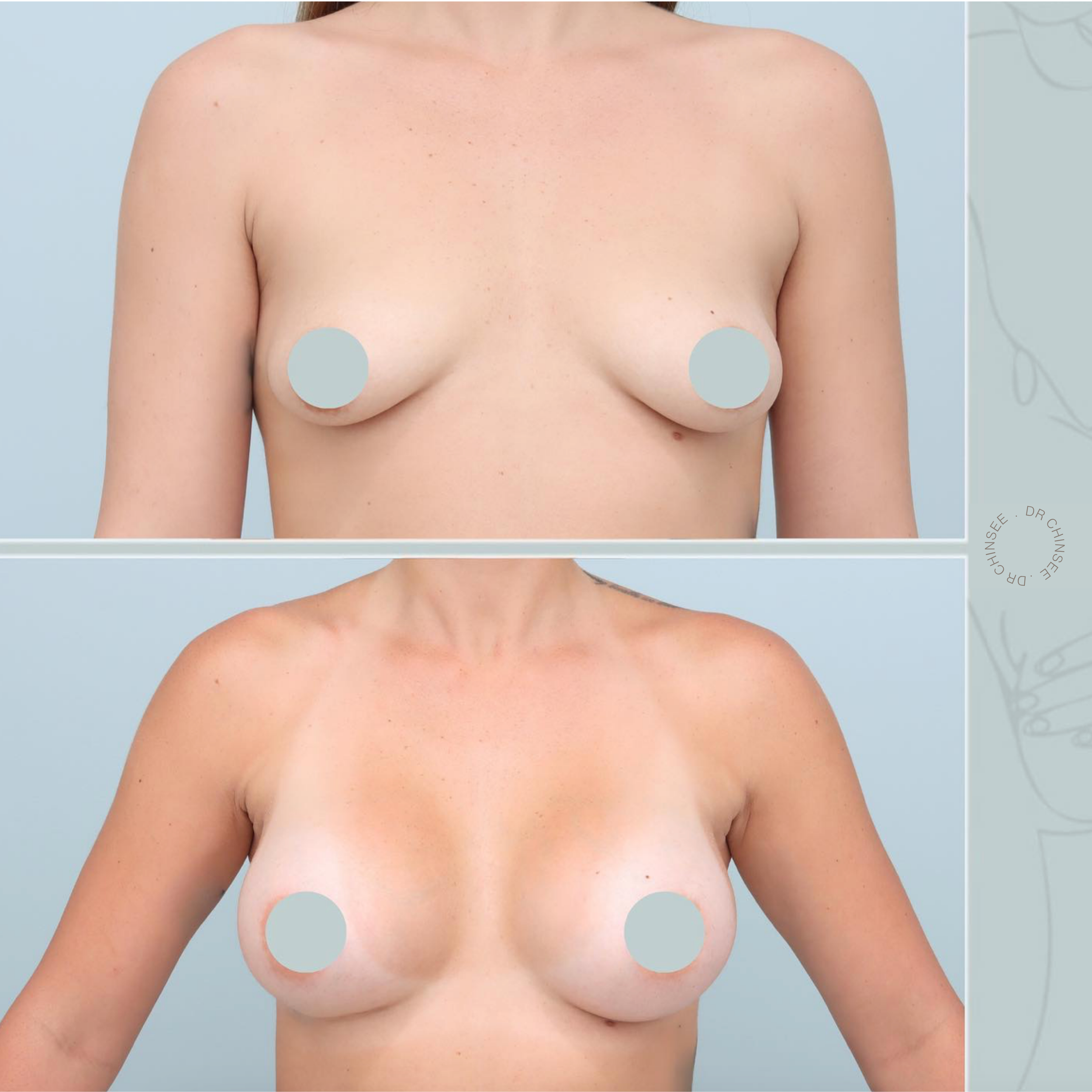 breast augmentation, breast surgery, breast augmentation brisbane, cosmetic breast surgery, dr ian chinsee