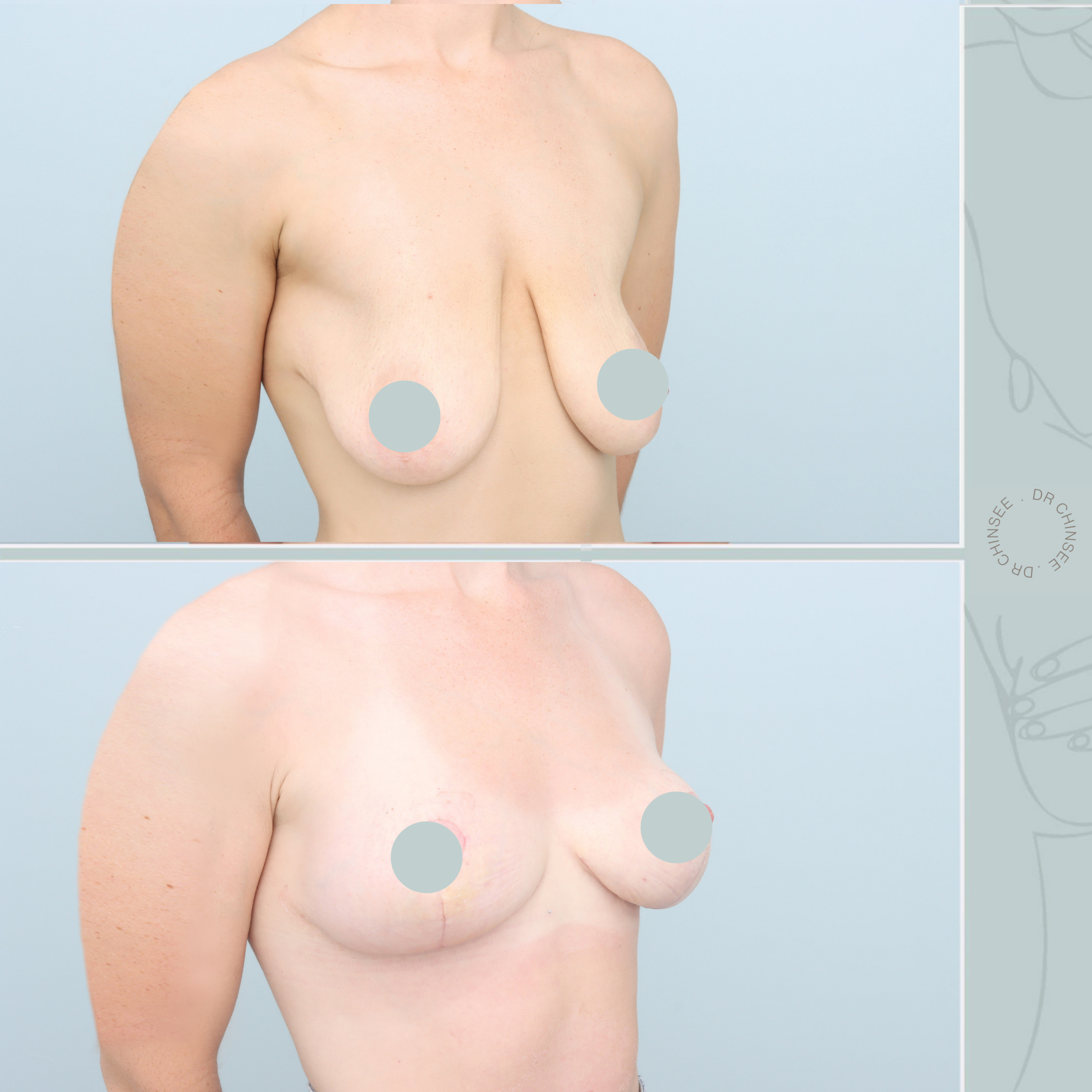 Mastopexy, breast lift, breast surgery, breast lift brisbane, mastopexy brisbane, cosmetic breast surgery, dr ian chinsee