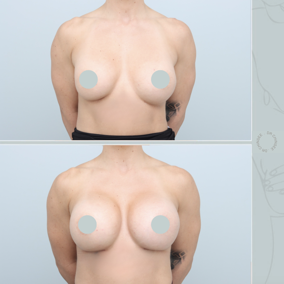 breast revision, removal and replacement, breast surgery, removal and replacement brisbane, breast revision brisbane, mastopexy brisbane, cosmetic breast surgery, dr ian chinsee