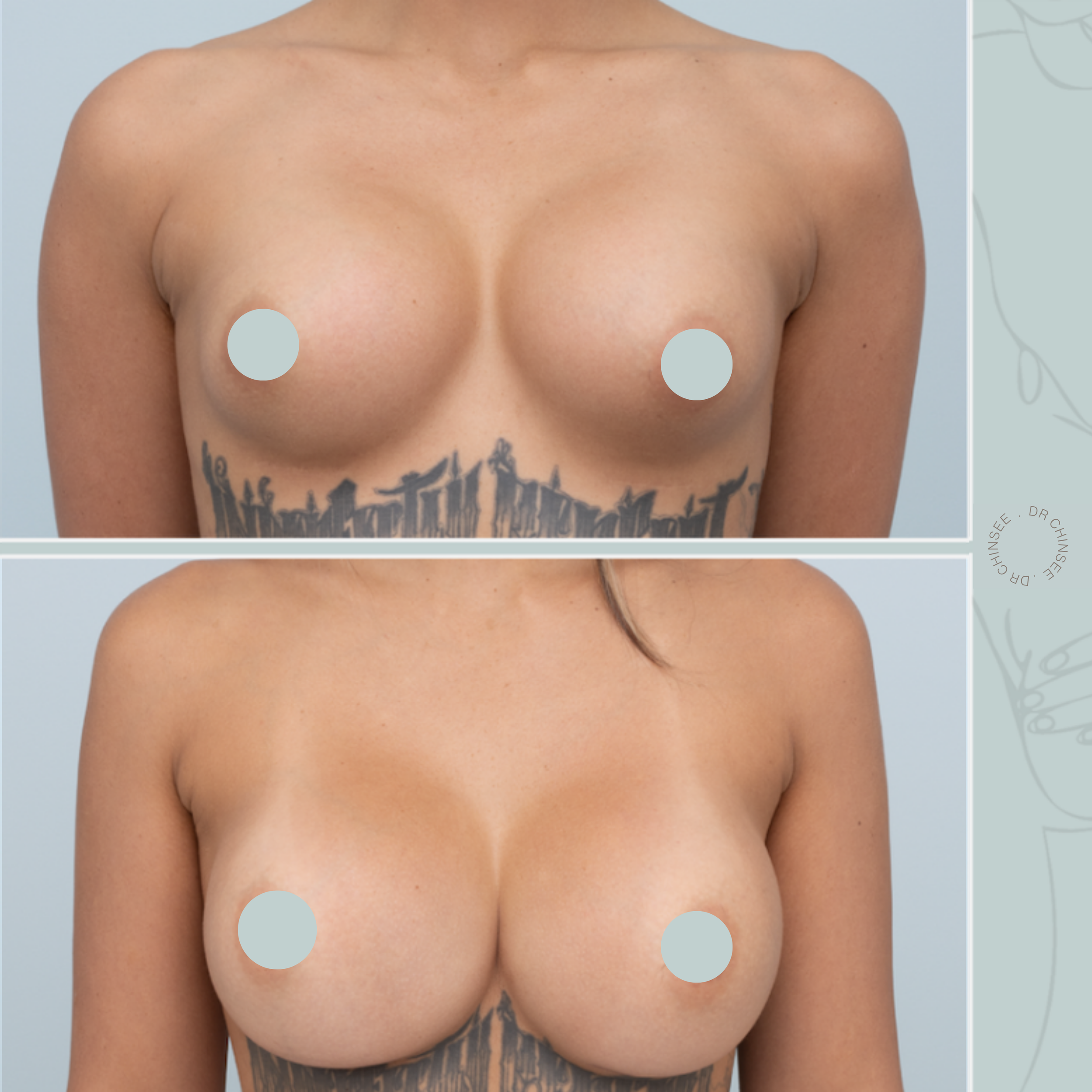 breast revision, removal and replacement, breast surgery, removal and replacement brisbane, breast revision brisbane, mastopexy brisbane, cosmetic breast surgery, dr ian chinsee