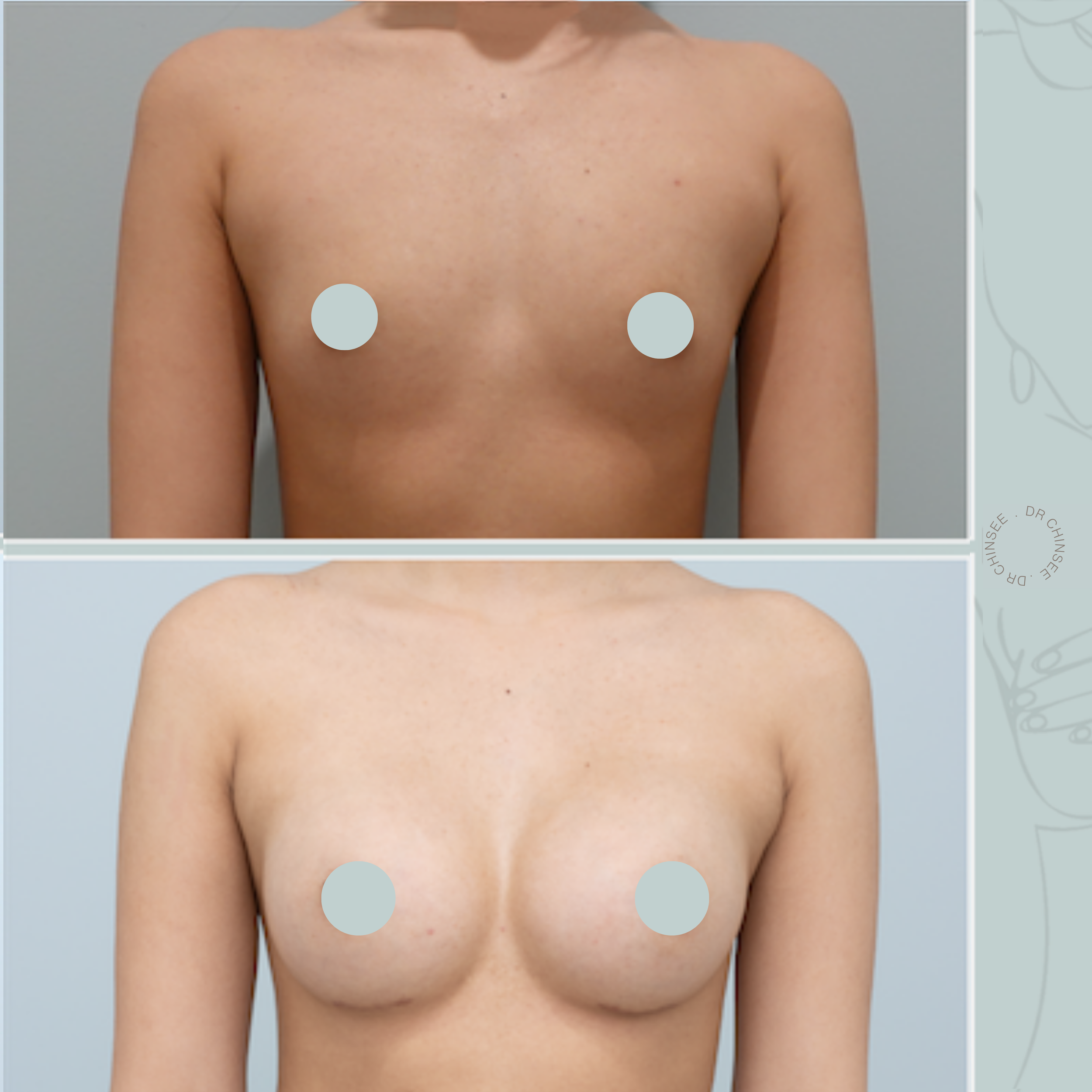 breast augmentation, breast surgery, breast augmentation brisbane, cosmetic breast surgery, dr ian chinsee