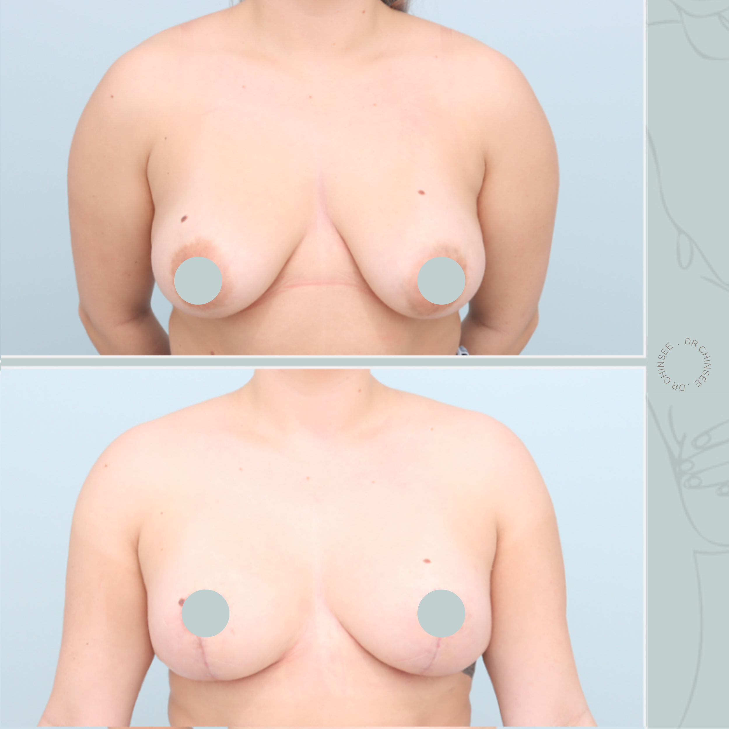 Mastopexy, breast lift, breast surgery, breast lift brisbane, mastopexy brisbane, cosmetic breast surgery, dr ian chinsee