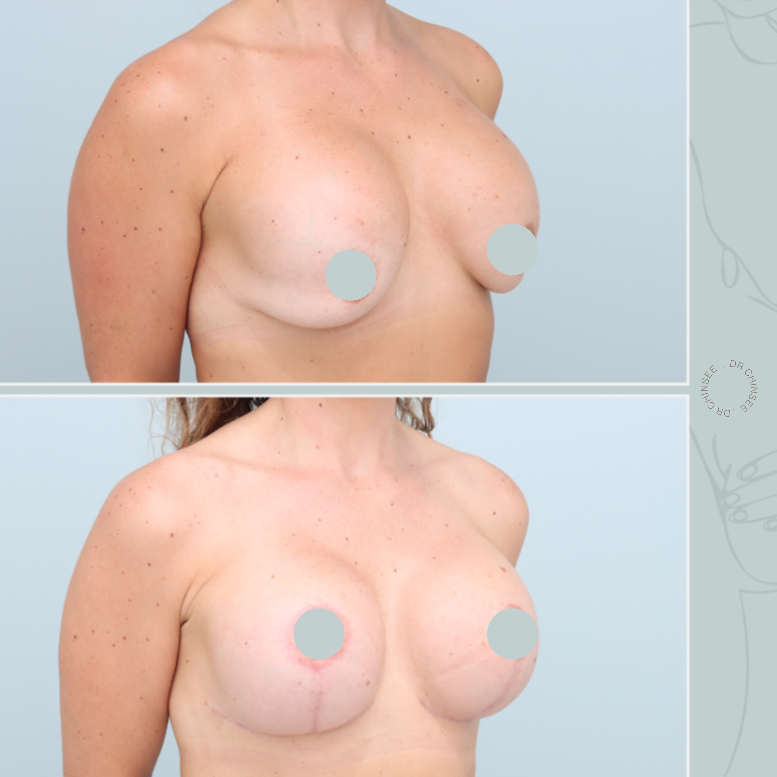 breast revision, removal and replacement, breast surgery, removal and replacement brisbane, breast revision brisbane, mastopexy brisbane, cosmetic breast surgery, dr ian chinsee