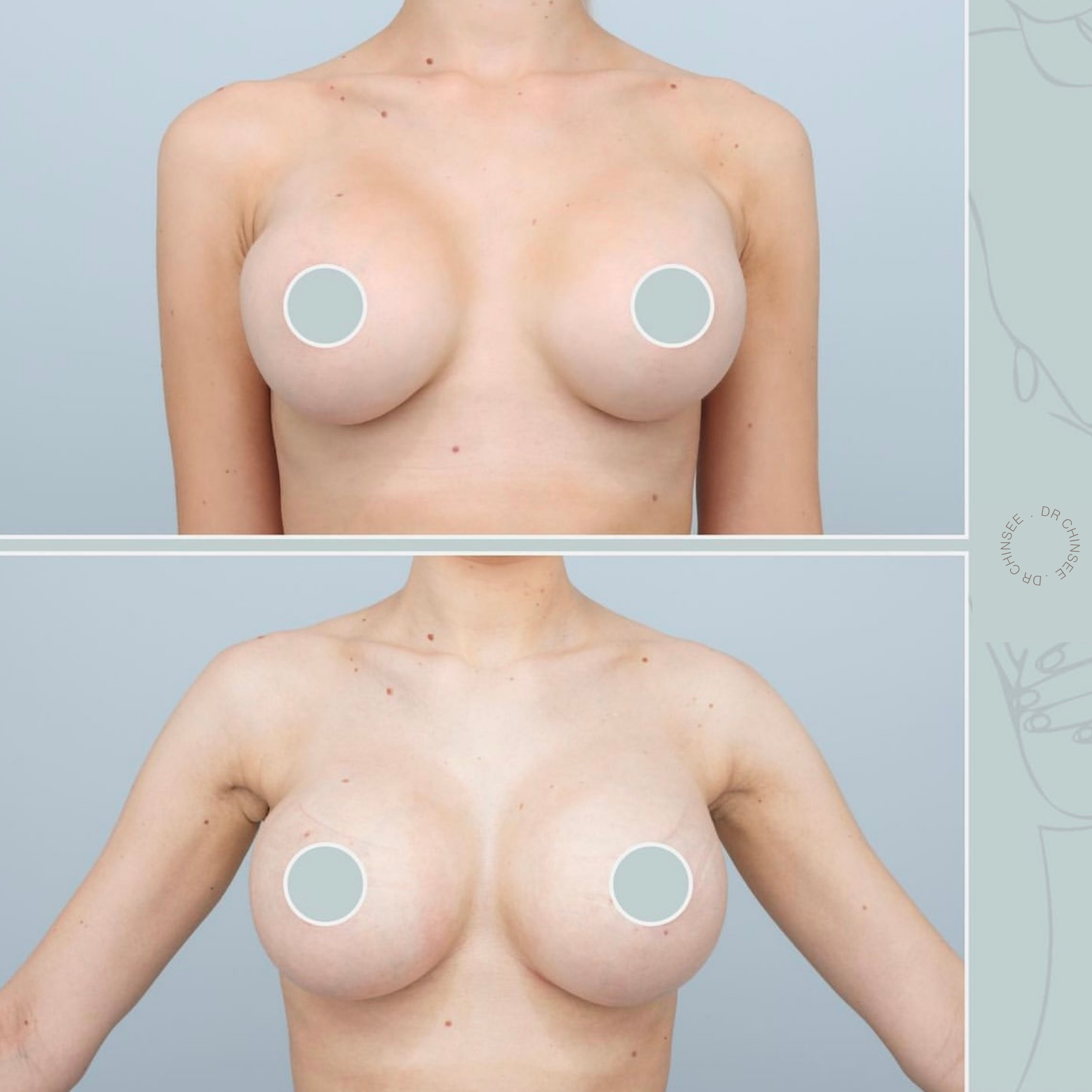 breast revision, removal and replacement, breast surgery, removal and replacement brisbane, breast revision brisbane, mastopexy brisbane, cosmetic breast surgery, dr ian chinsee