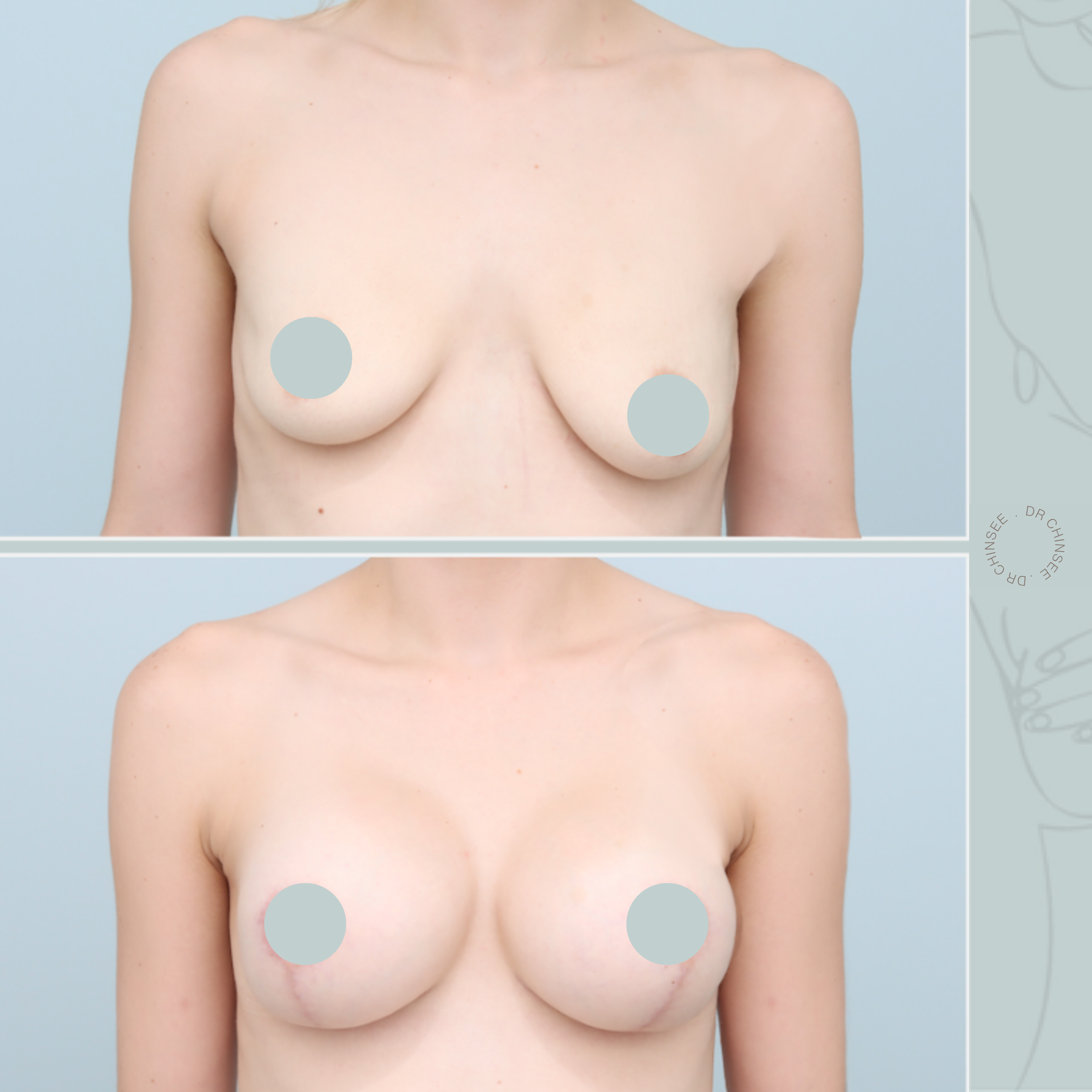 breast augmentation & mastopexy, breast lift, breast surgery, breast augmentation brisbane, breast lift brisbane, mastopexy brisbane, cosmetic breast surgery, dr ian chinsee