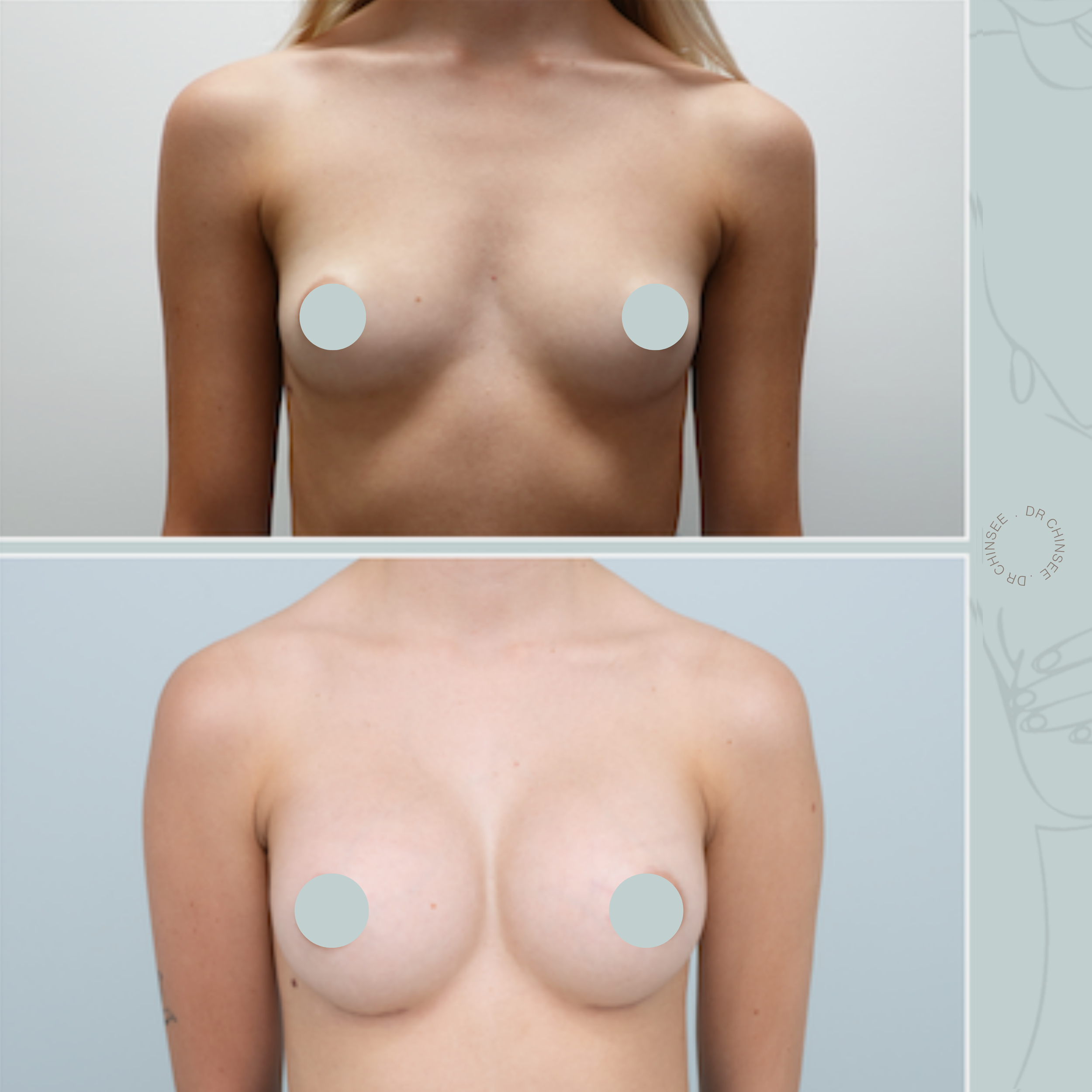 breast augmentation, breast surgery, breast augmentation brisbane, cosmetic breast surgery, dr ian chinsee