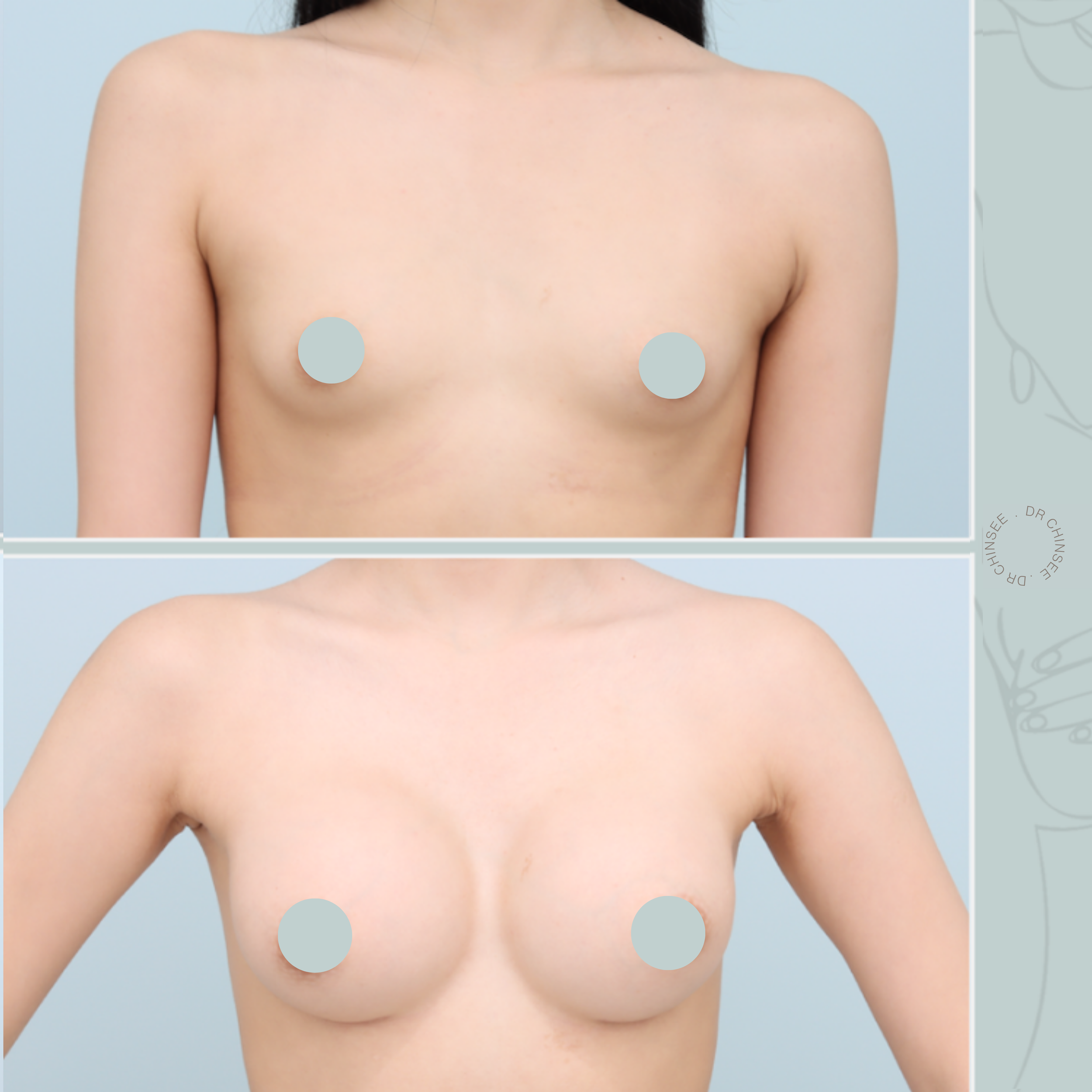 breast augmentation, breast surgery, breast augmentation brisbane, cosmetic breast surgery, dr ian chinsee