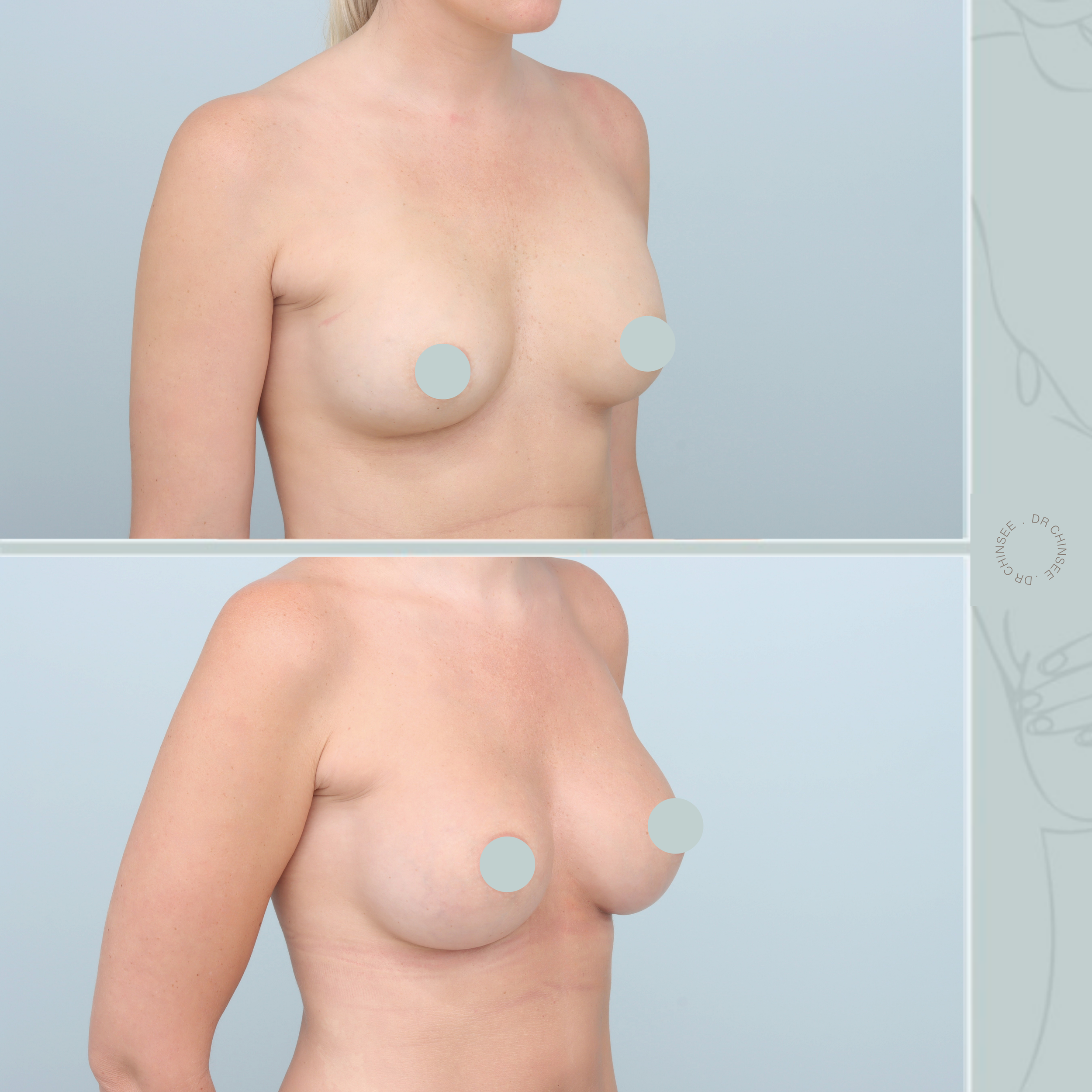 breast augmentation, breast surgery, breast augmentation brisbane, cosmetic breast surgery, dr ian chinsee