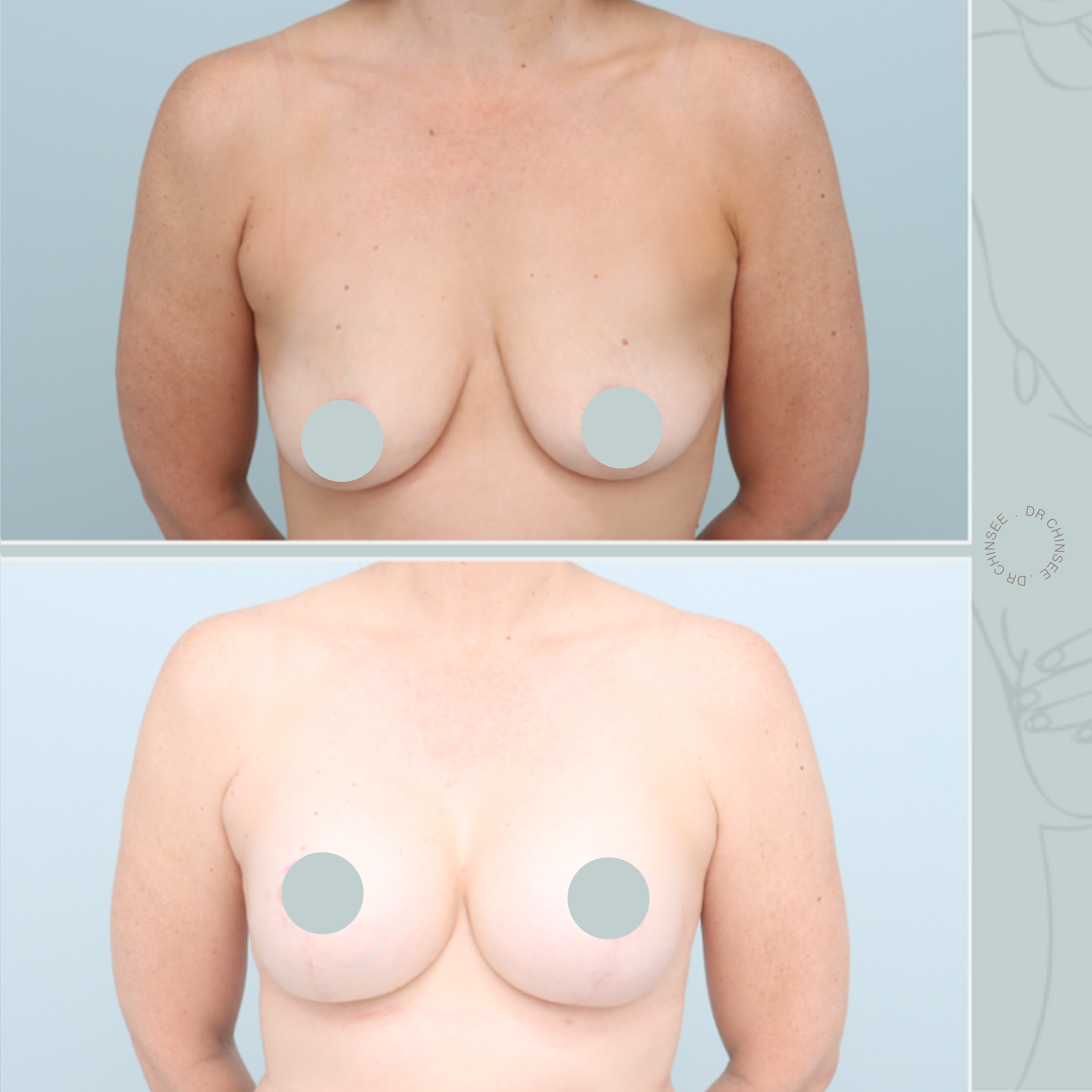 breast augmentation & mastopexy, breast lift, breast surgery, breast augmentation brisbane, breast lift brisbane, mastopexy brisbane, cosmetic breast surgery, dr ian chinsee