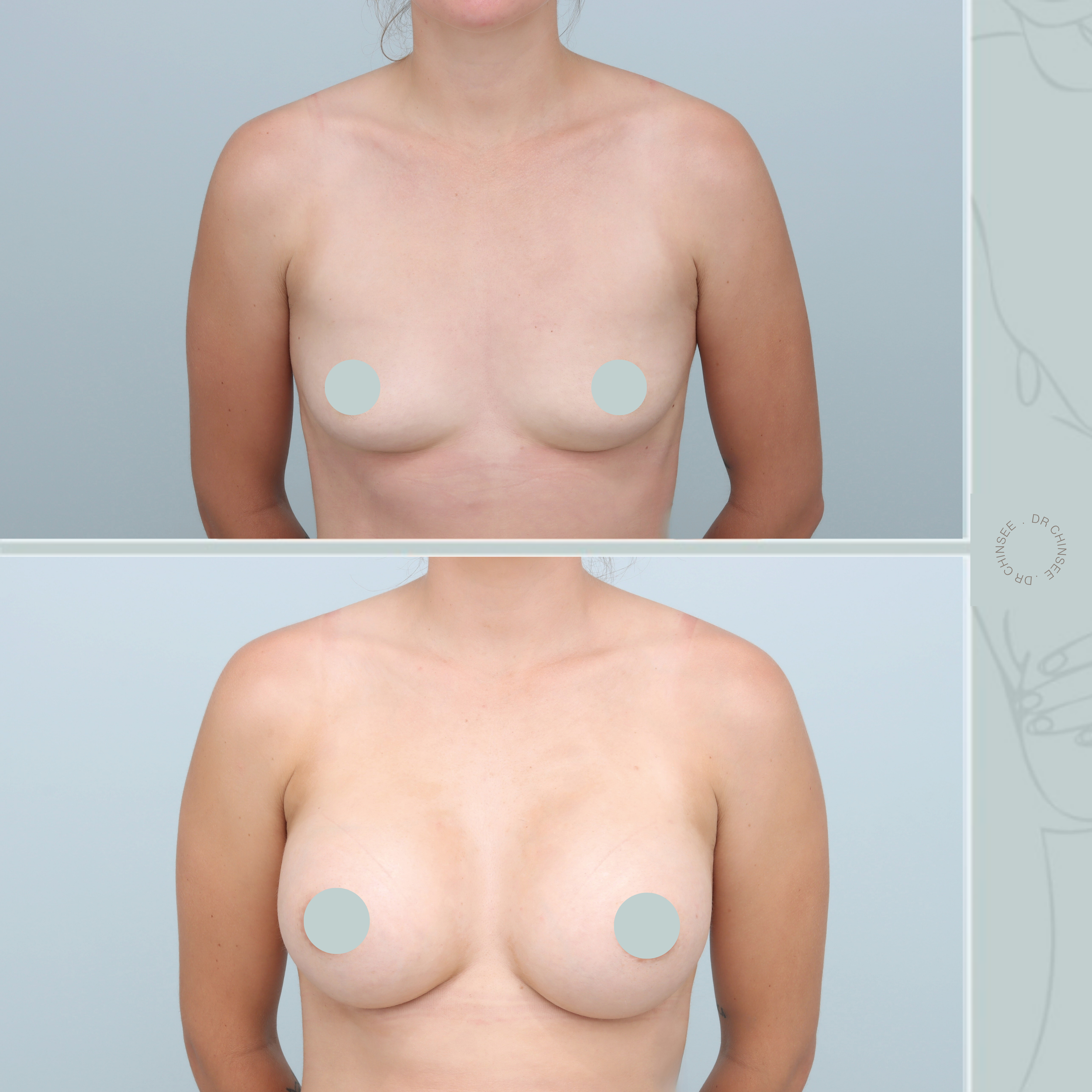 breast augmentation, breast surgery, breast augmentation brisbane, cosmetic breast surgery, dr ian chinsee