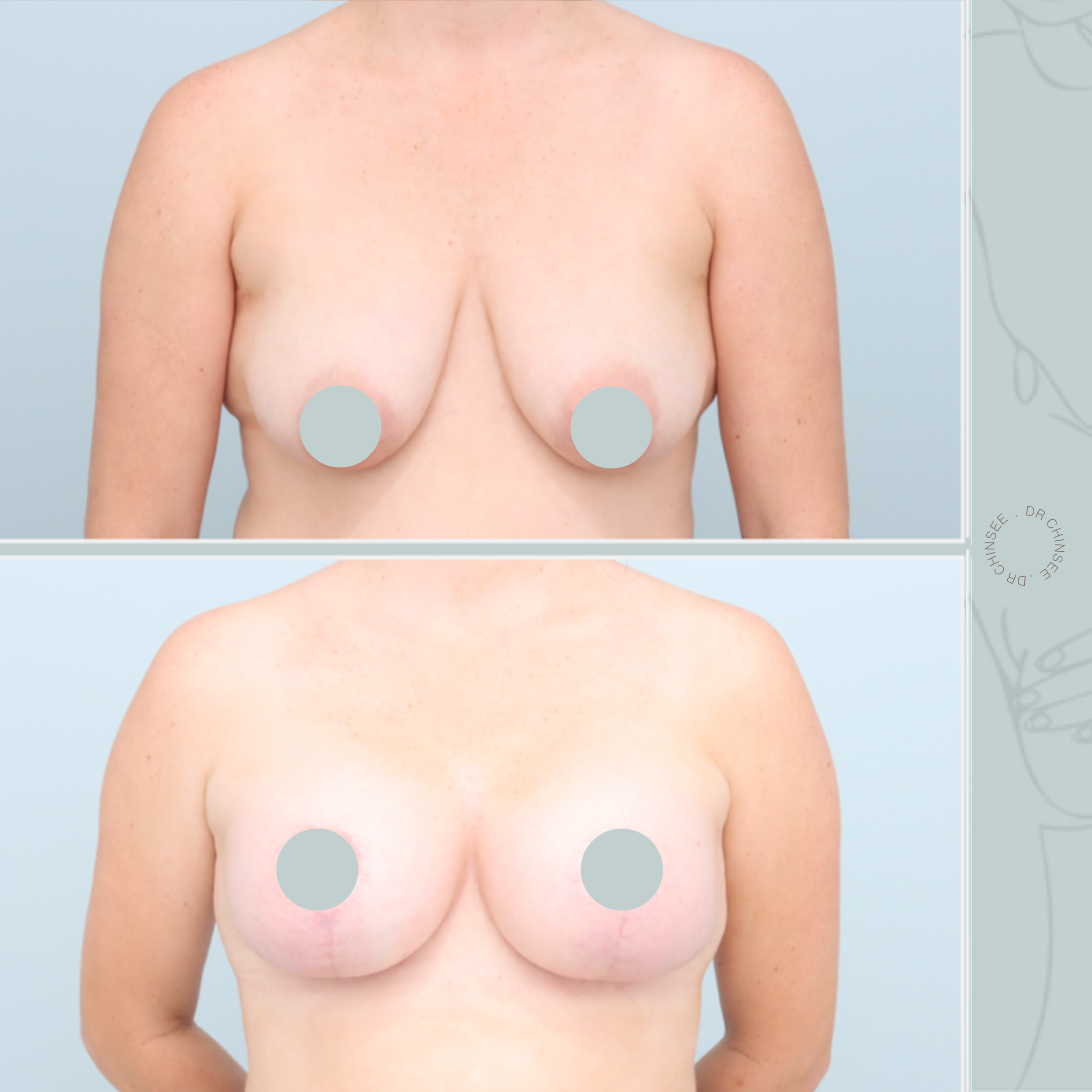 breast augmentation & mastopexy, breast lift, breast surgery, breast augmentation brisbane, breast lift brisbane, mastopexy brisbane, cosmetic breast surgery, dr ian chinsee