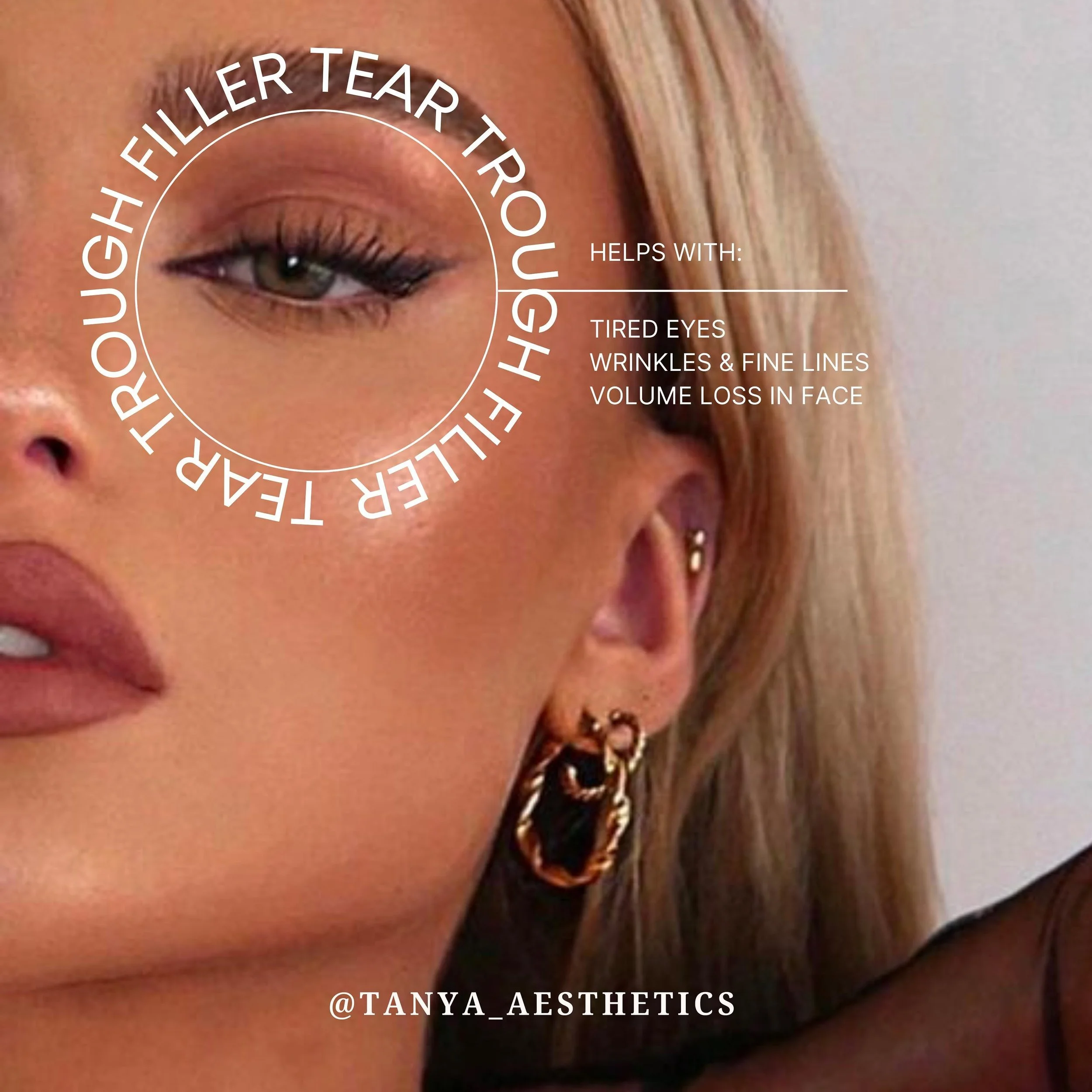 Embracing the journey to brighter eyes and lighter burdens. ✨ #TearTroughTransformation #FreshStart

Tear trough filler is where hyaluronic acid-based fillers are injected under the eyes to reduce the appearance of dark circles, hollows, or bags. It 