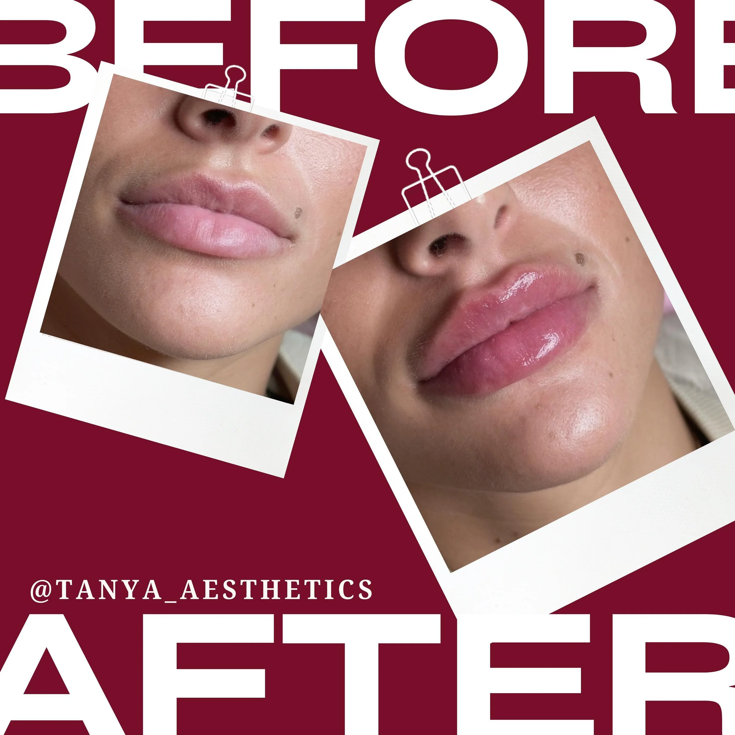 💋✨ Say hello to plump perfection with our Russian lip technique! 💉👄 Enhancing these beautiful lips ✨💋Before &amp; After 📸

This technique achieves desired fullness and definition without the drawbacks of migration or overfilling.